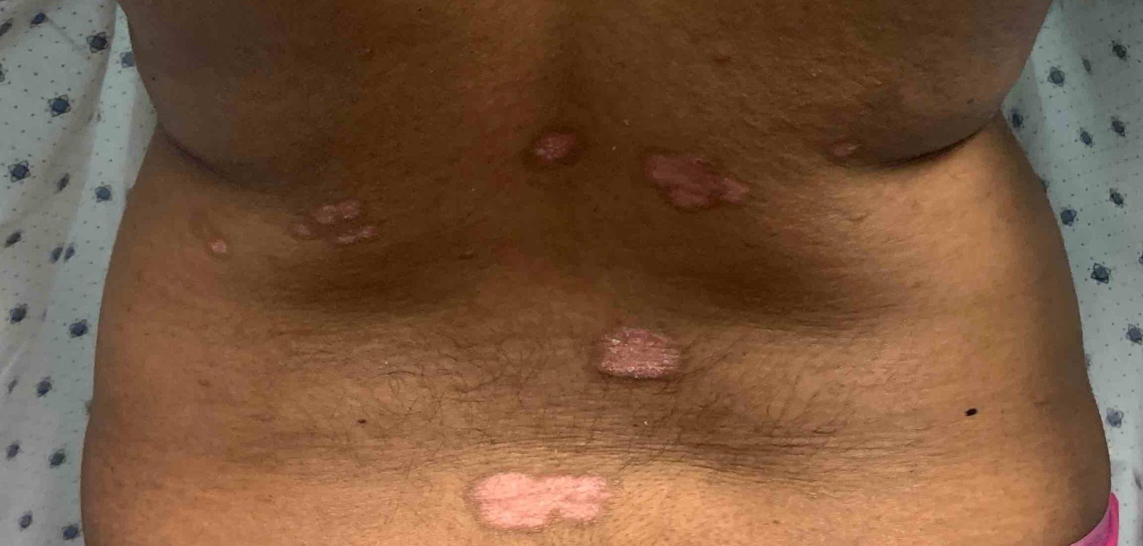 Psoriasis (6 Month Cosentyx) Case-58 Before