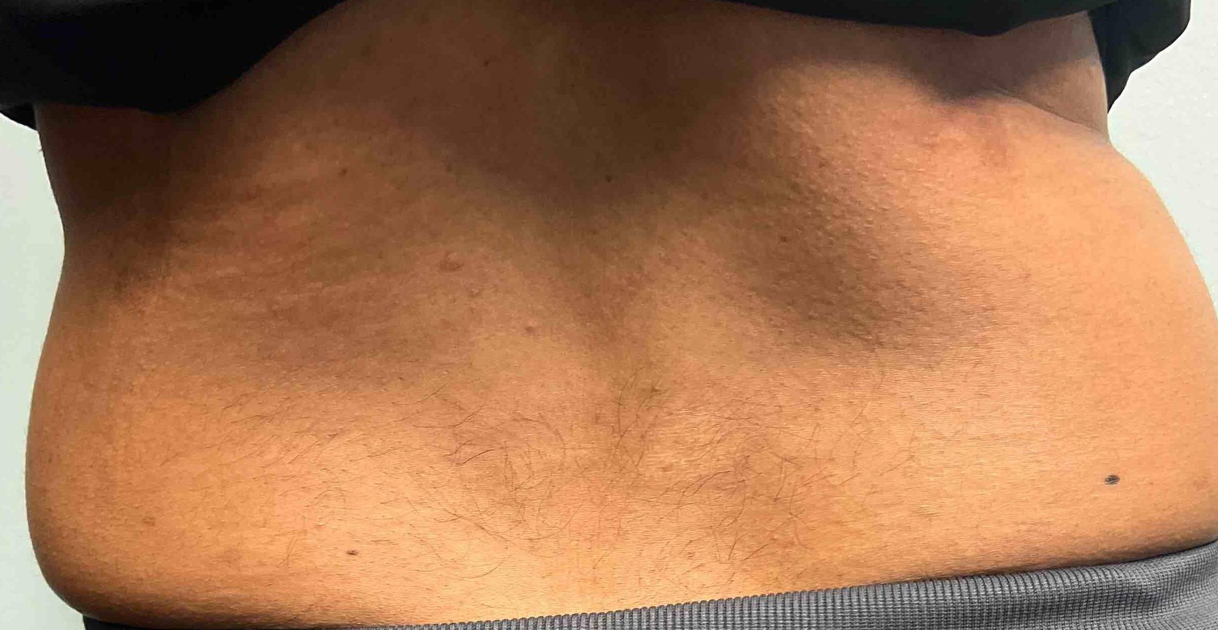 Psoriasis (6 Month Cosentyx) Case-58 After