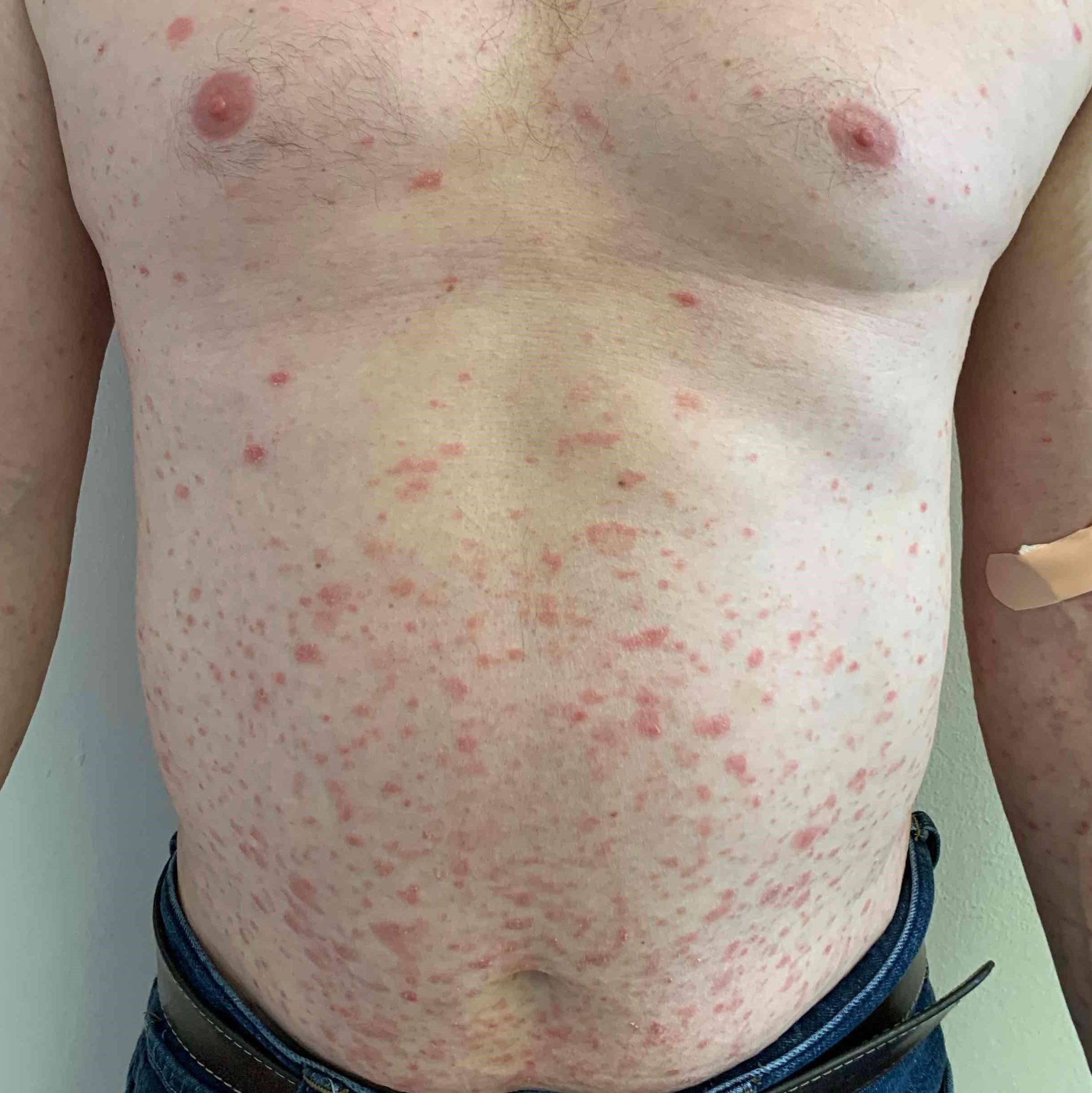 Psoriasis (3 Months Skyrizi ) Case-59 Before