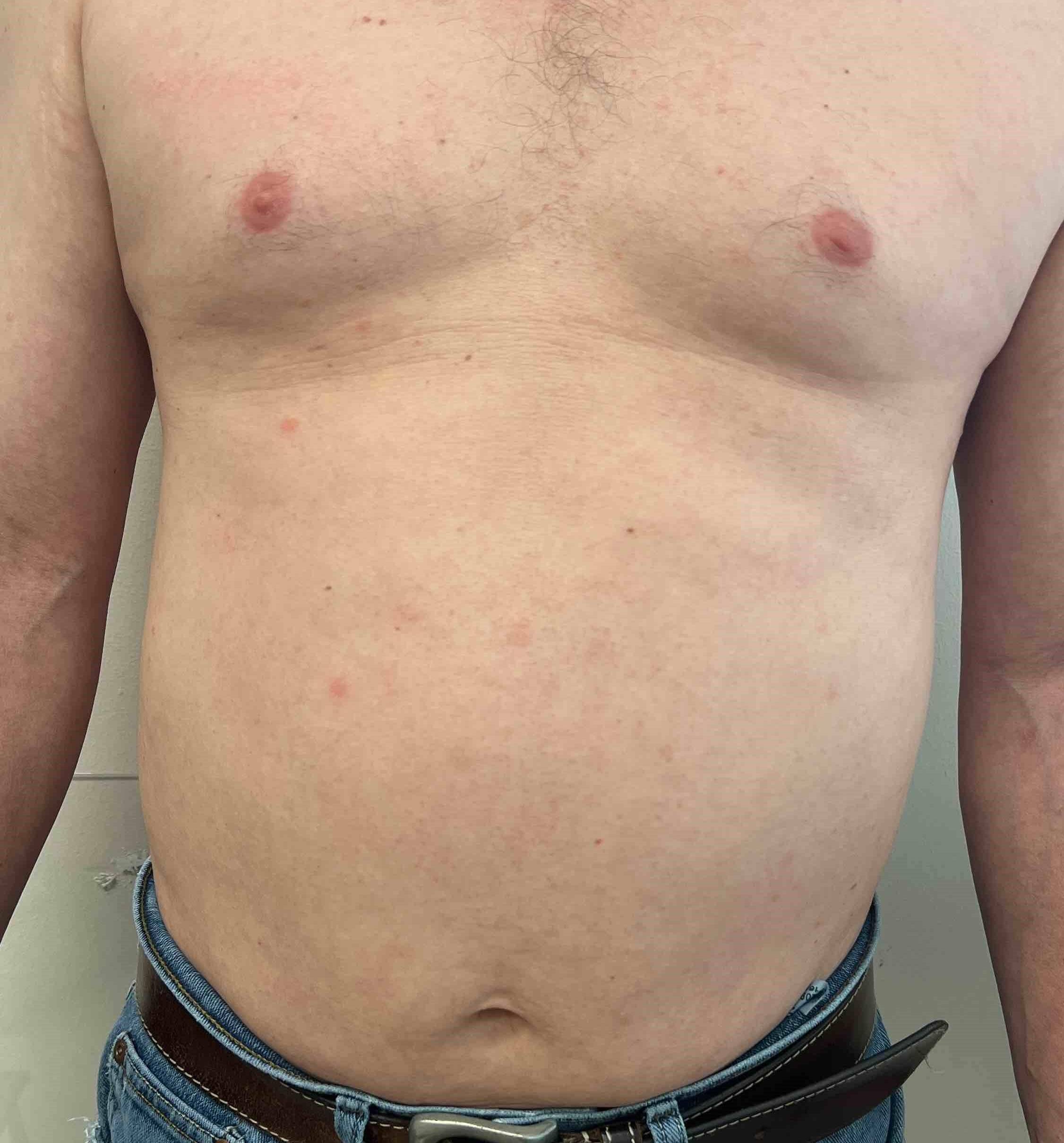 Psoriasis (3 Months Skyrizi ) Case-59 After