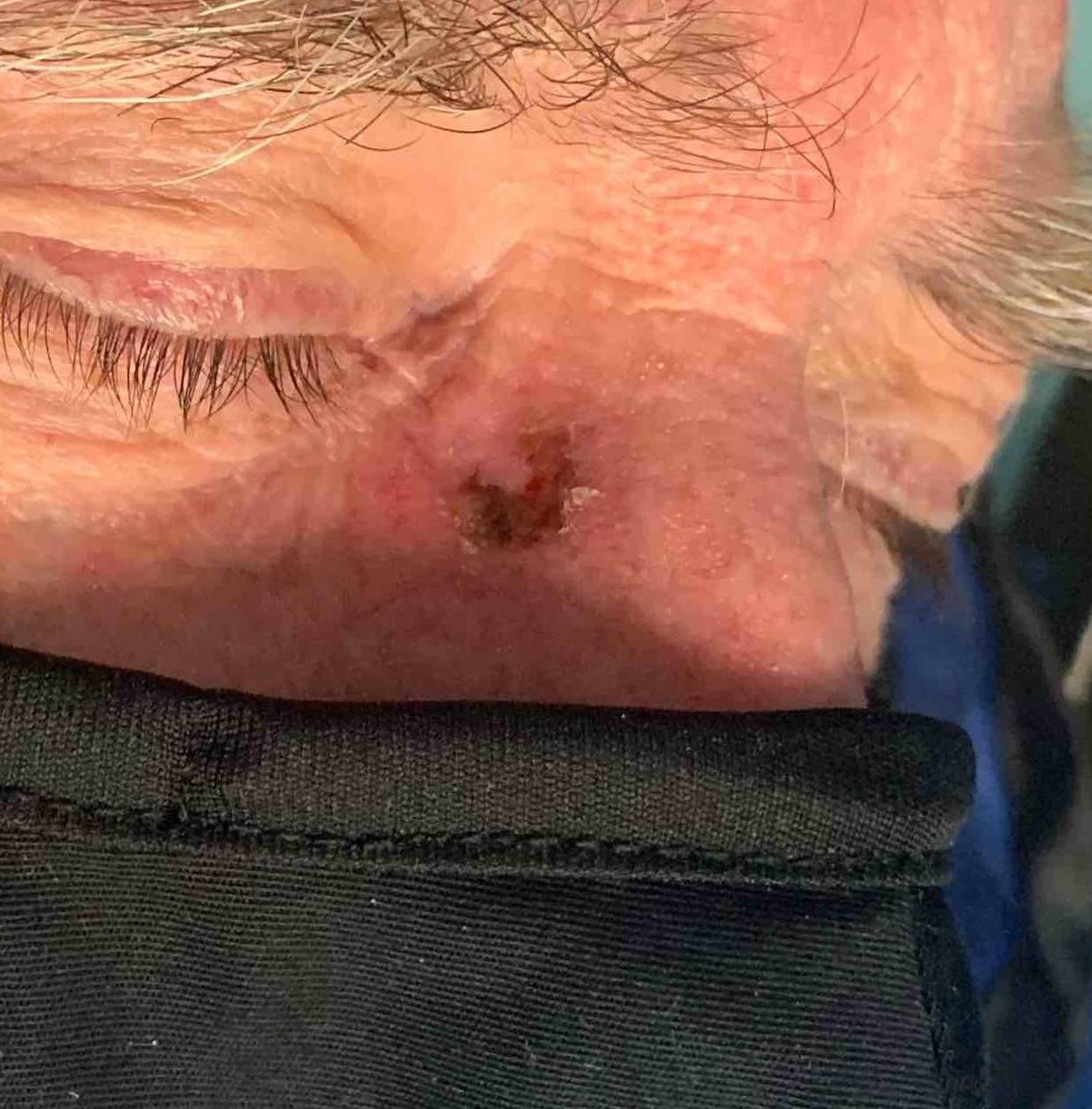 Skin Cancer (17 Treatments) Case-44 Before