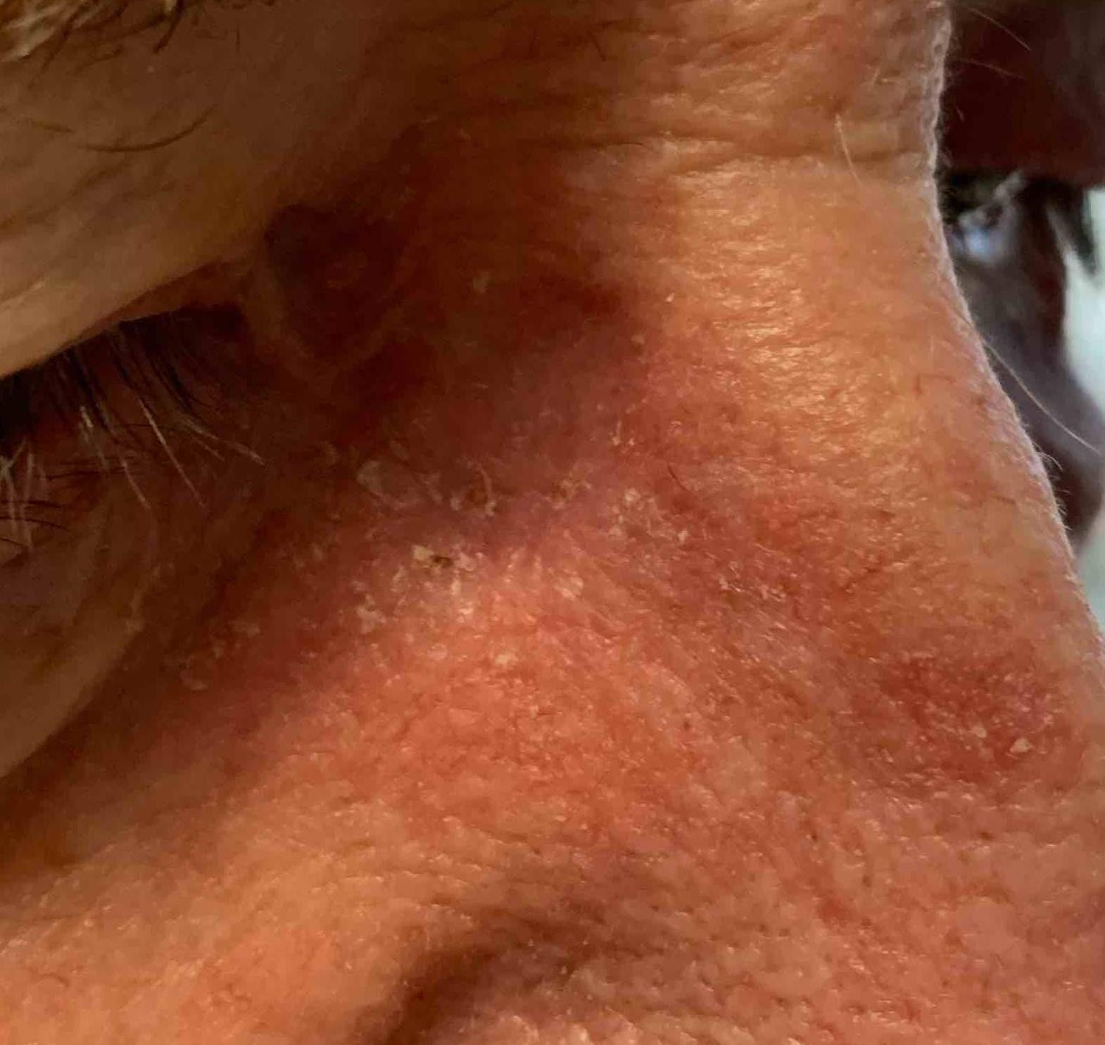 Skin Cancer (17 Treatments) Case-44 After