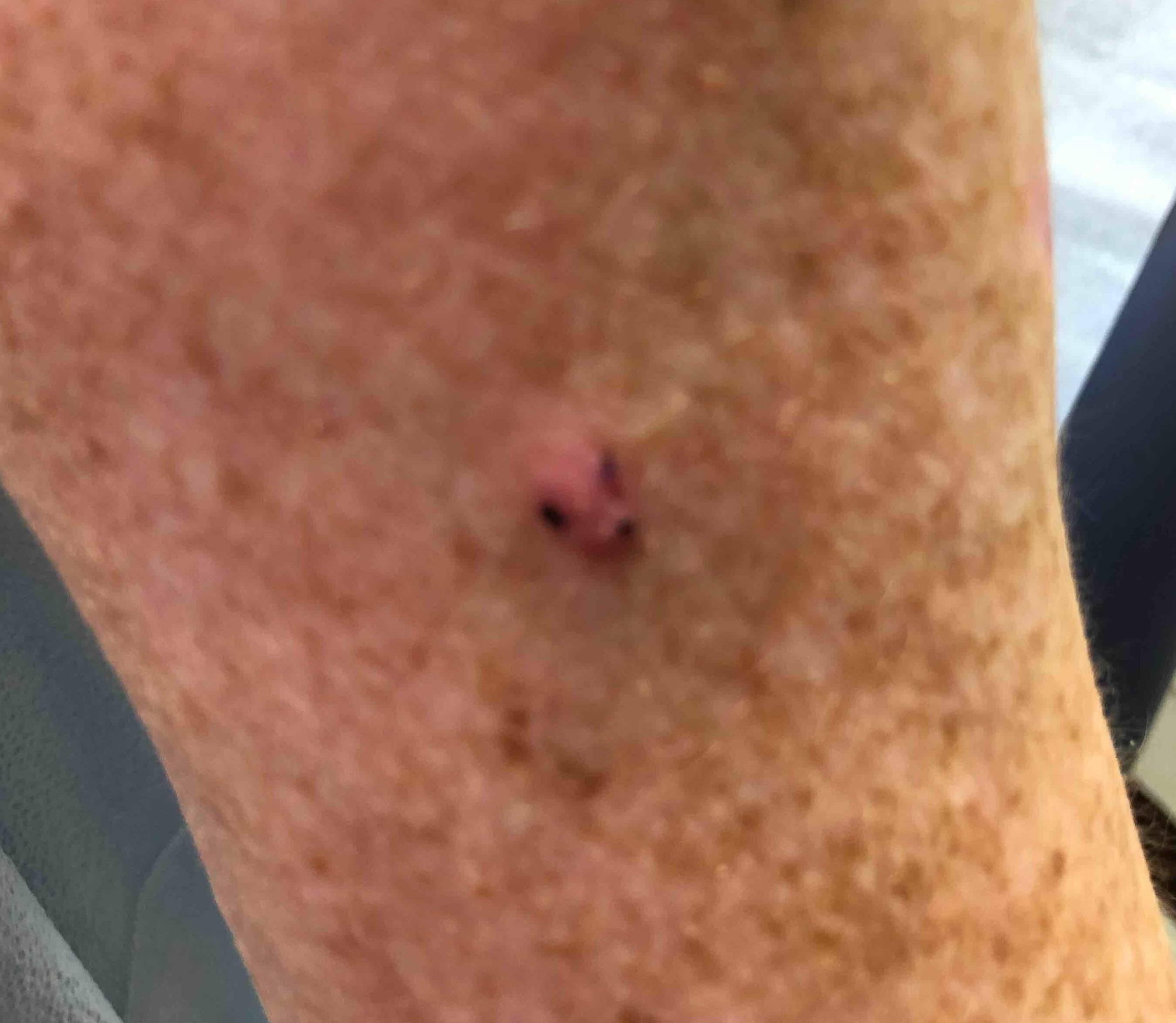 Skin Cancer (14 Treatments) Case-45 Before
