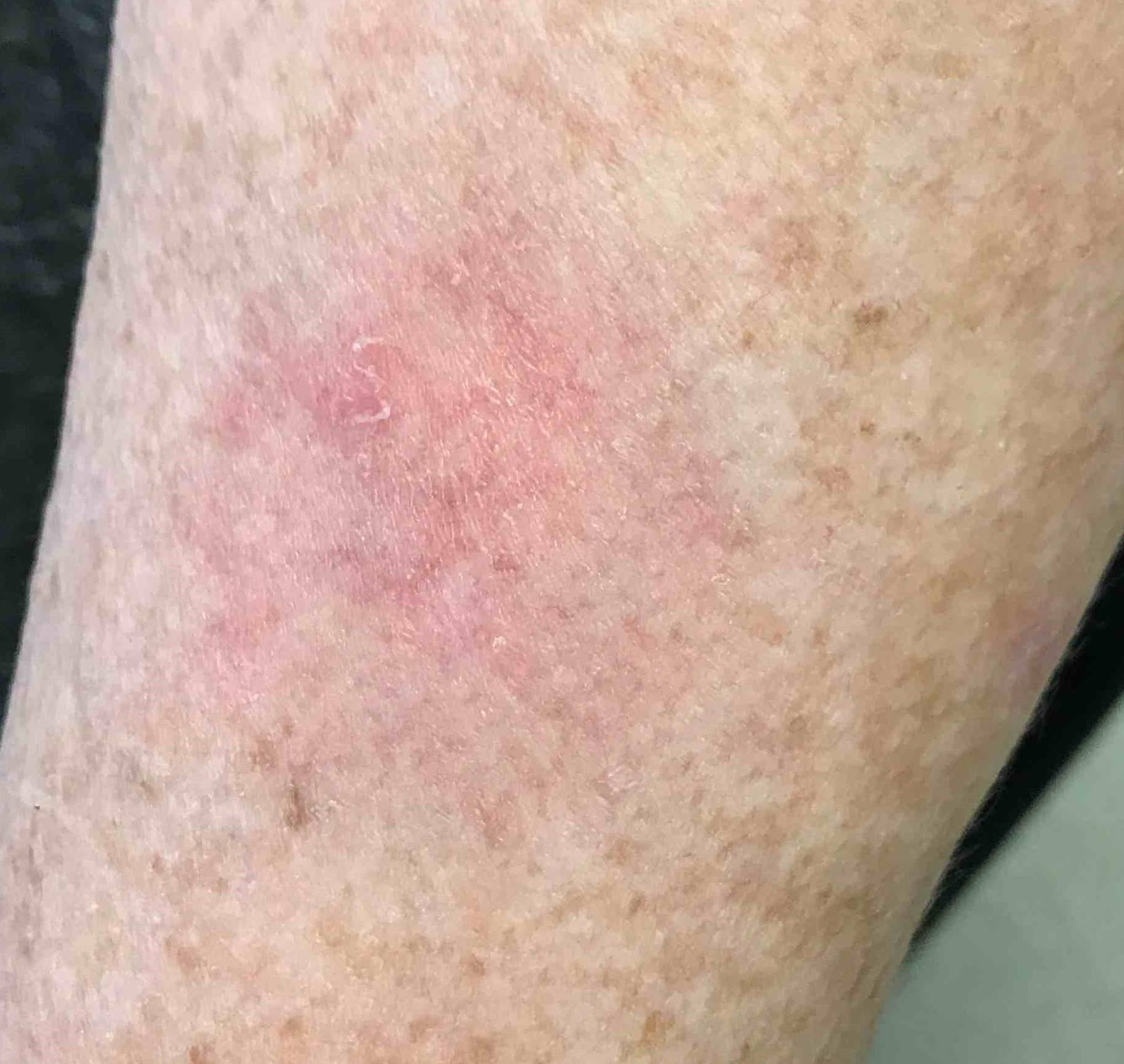 Skin Cancer (14 Treatments) Case-45 After