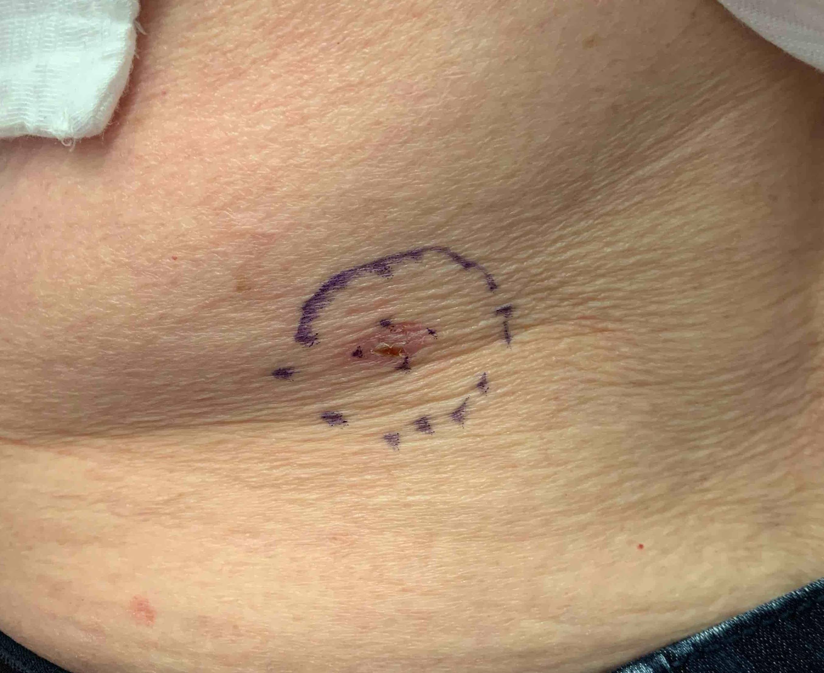 Skin Cancer (Excision) Case-46 Before