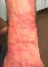 Eczema Before and After Case 4 Before