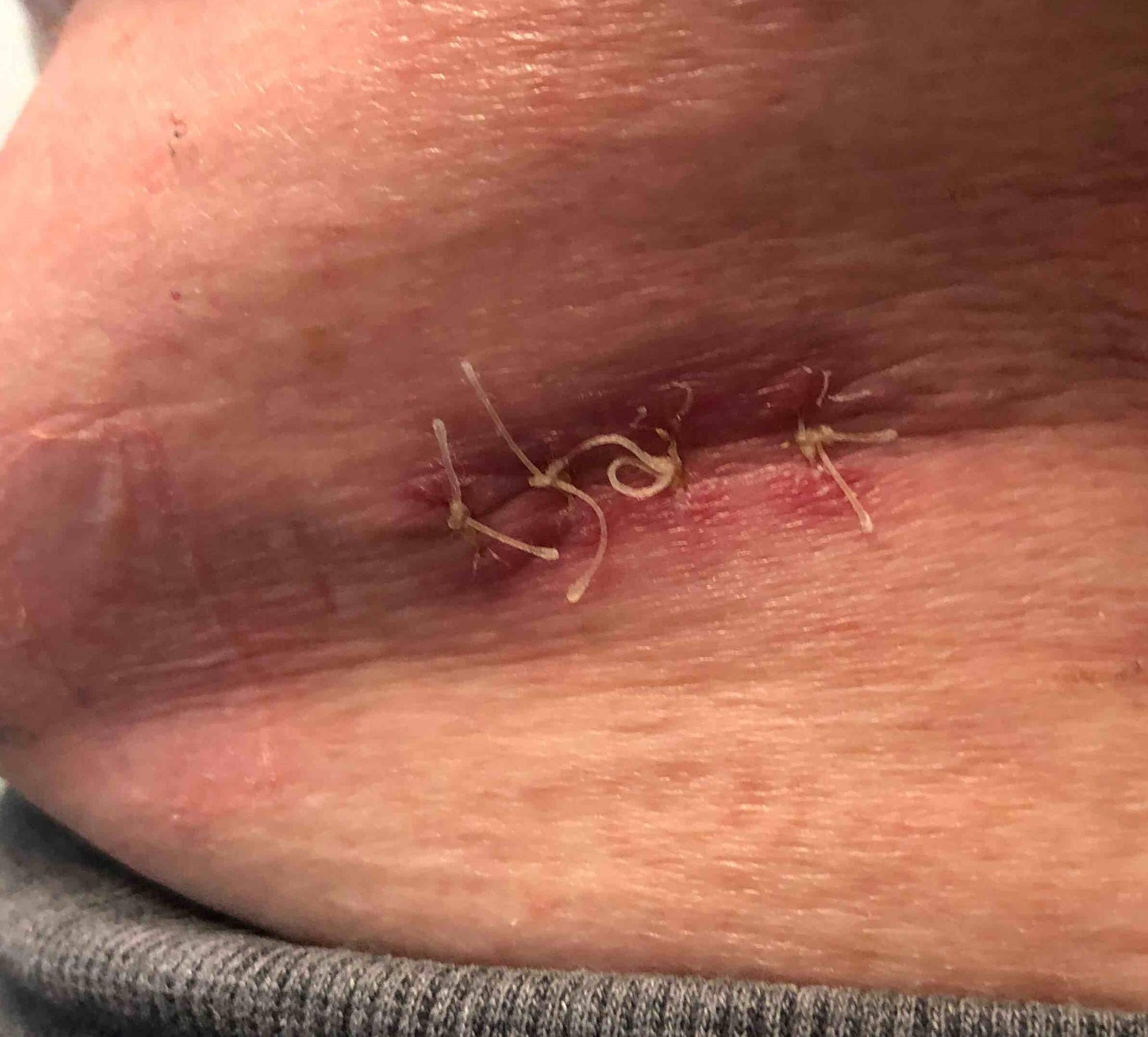Skin Cancer (Excision) Case-46 After