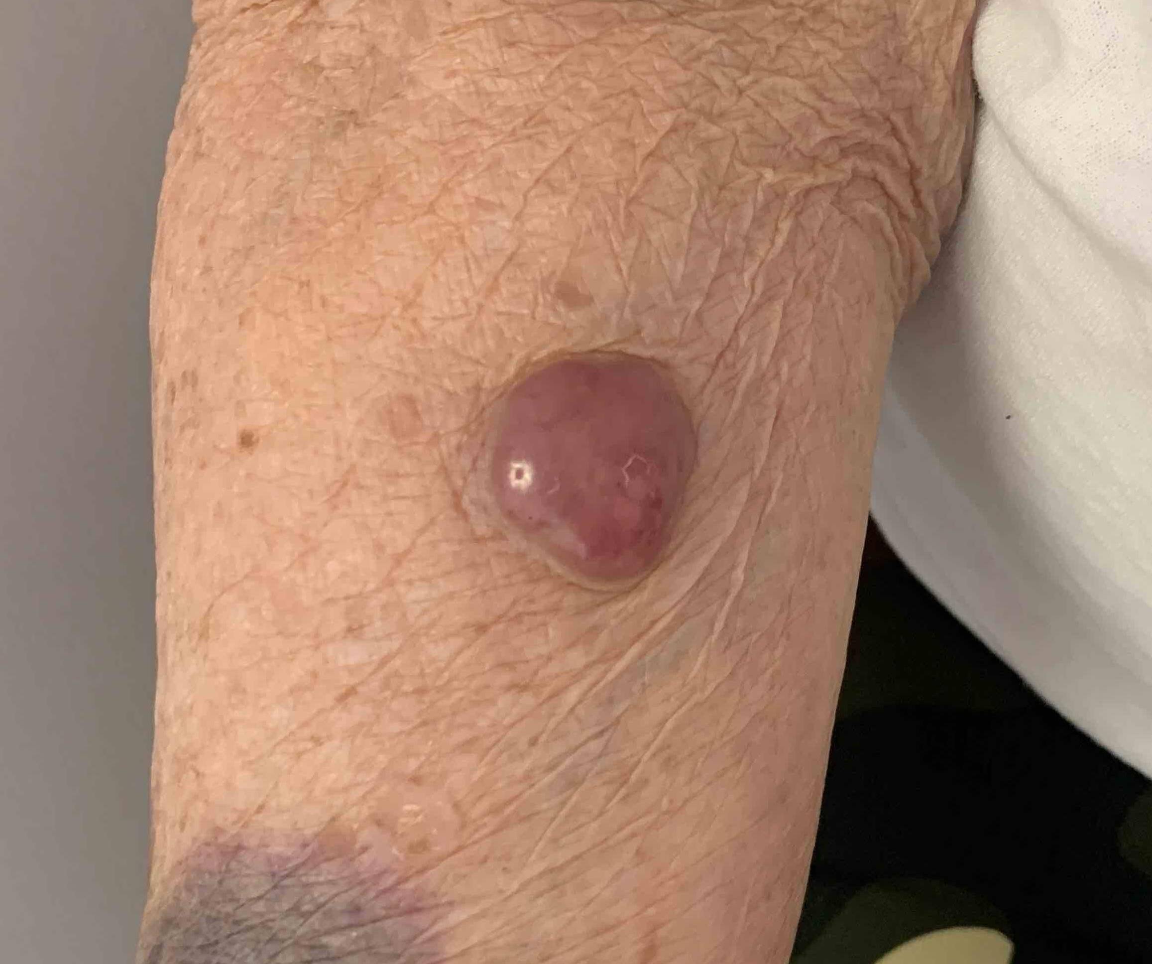 Skin Cancer (Excision) Case-47 Before