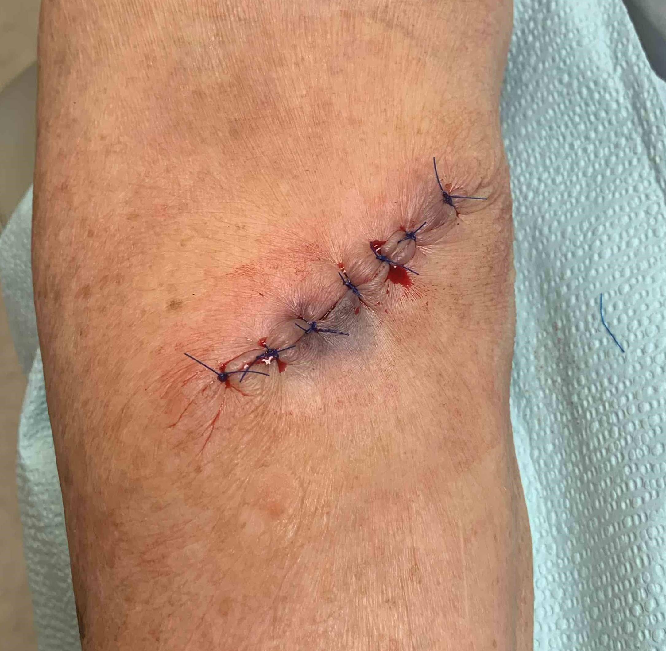 Skin Cancer (Excision) Case-47 After