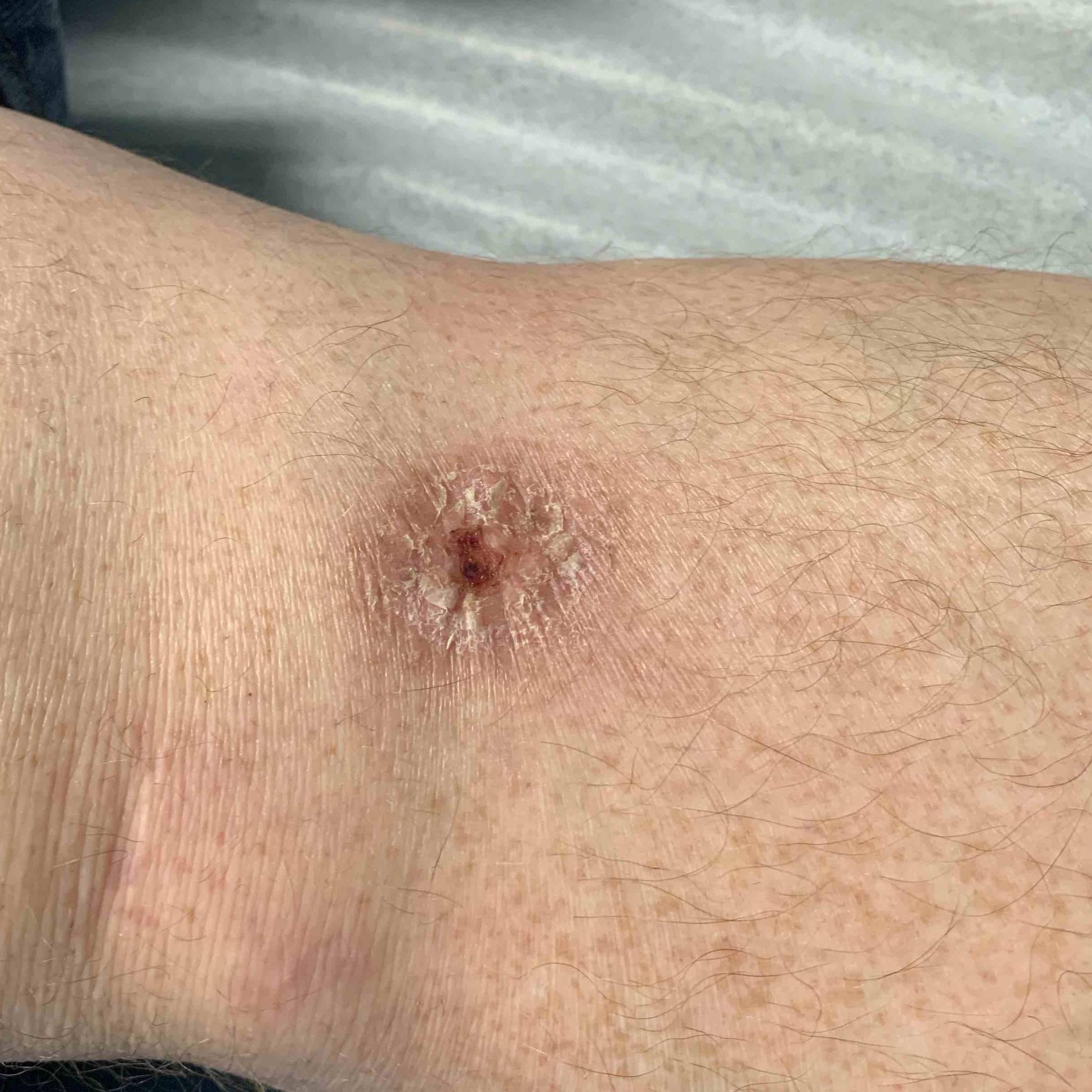 Skin Cancer (17 Treatments) Case-48 Before