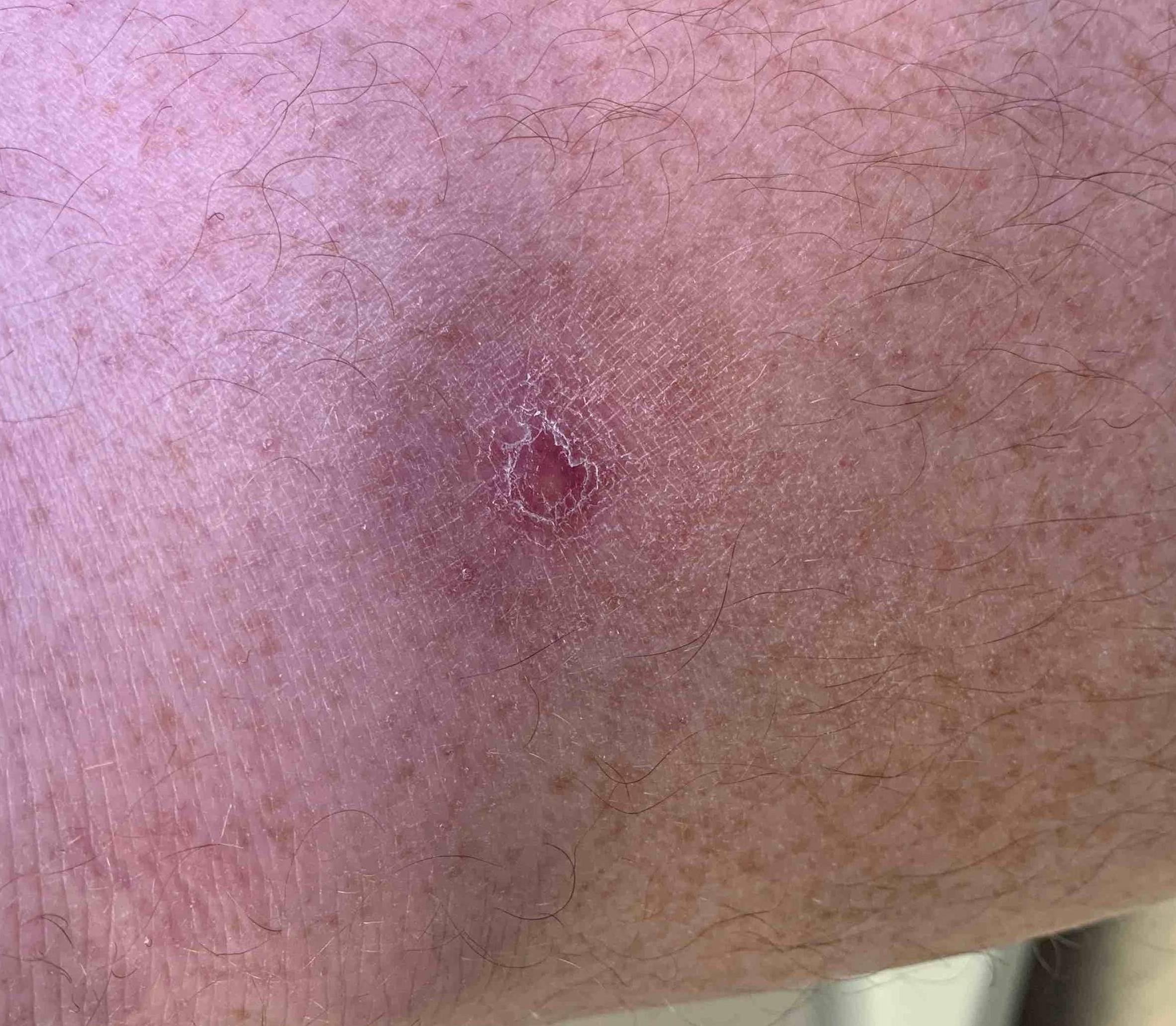 Skin Cancer (17 Treatments) Case-48 After