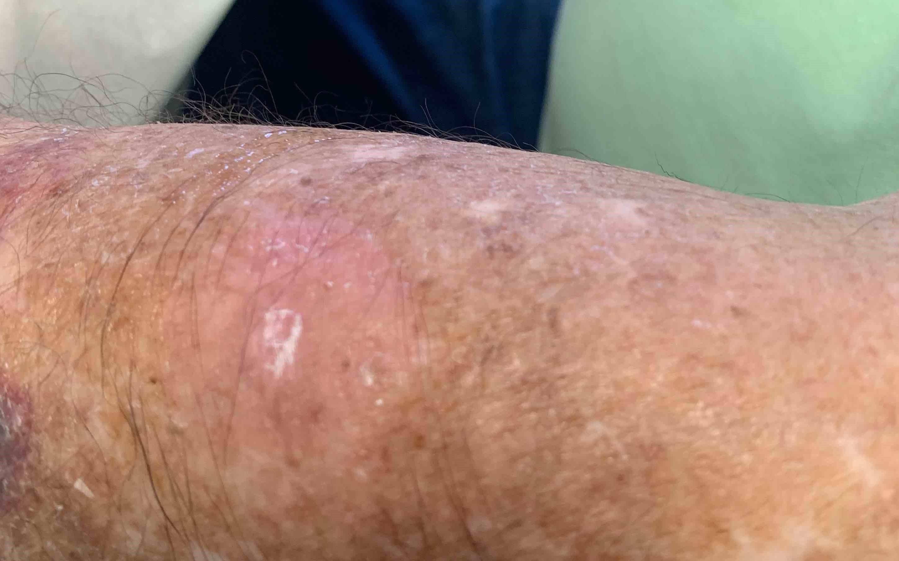 Skin Cancer (14 Treatments) Case-49 After