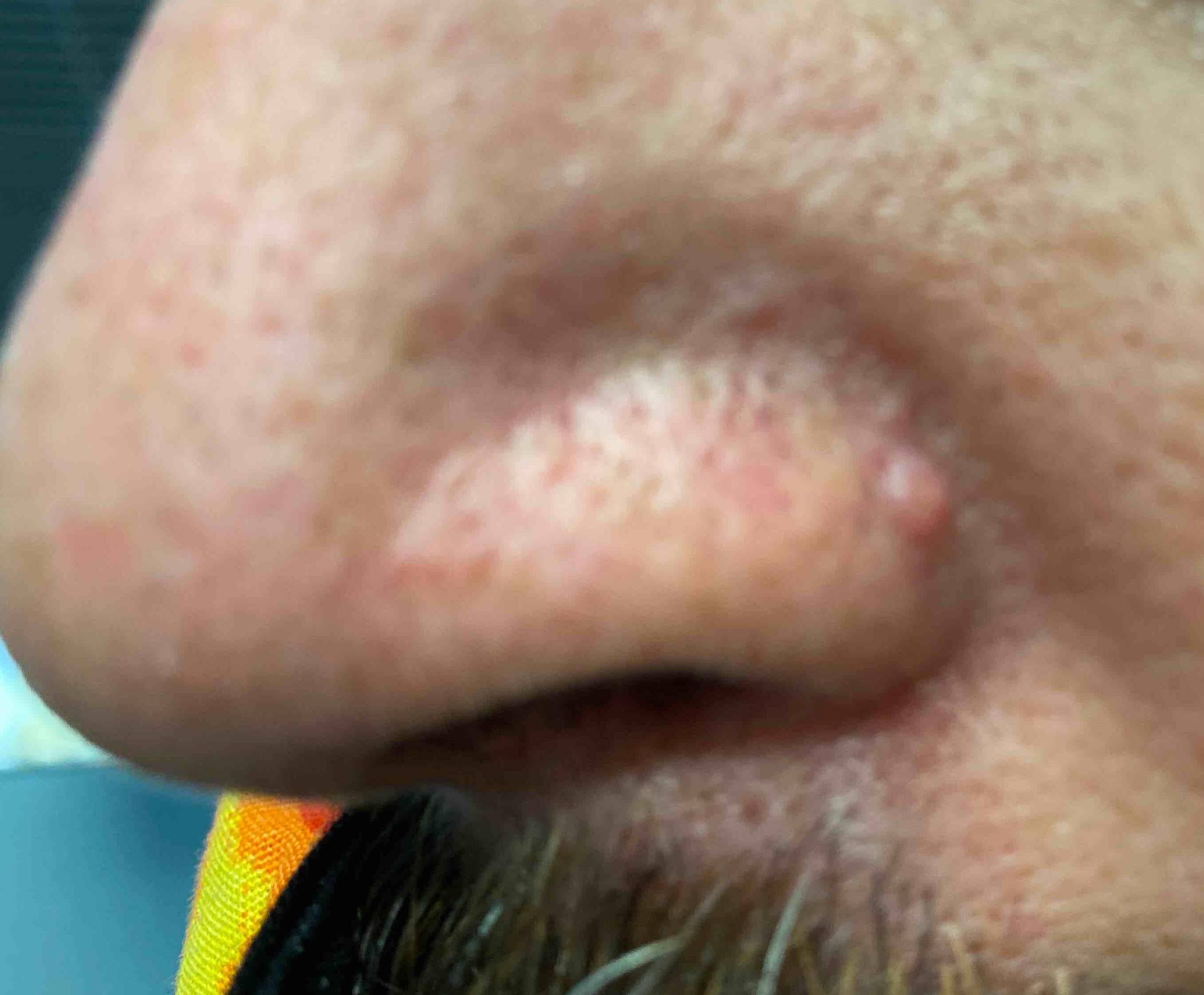 Skin Cancer (18 Radiation Treatment) Case-50 Before