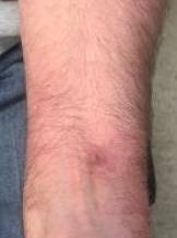 Eczema Before and After Case 4 After