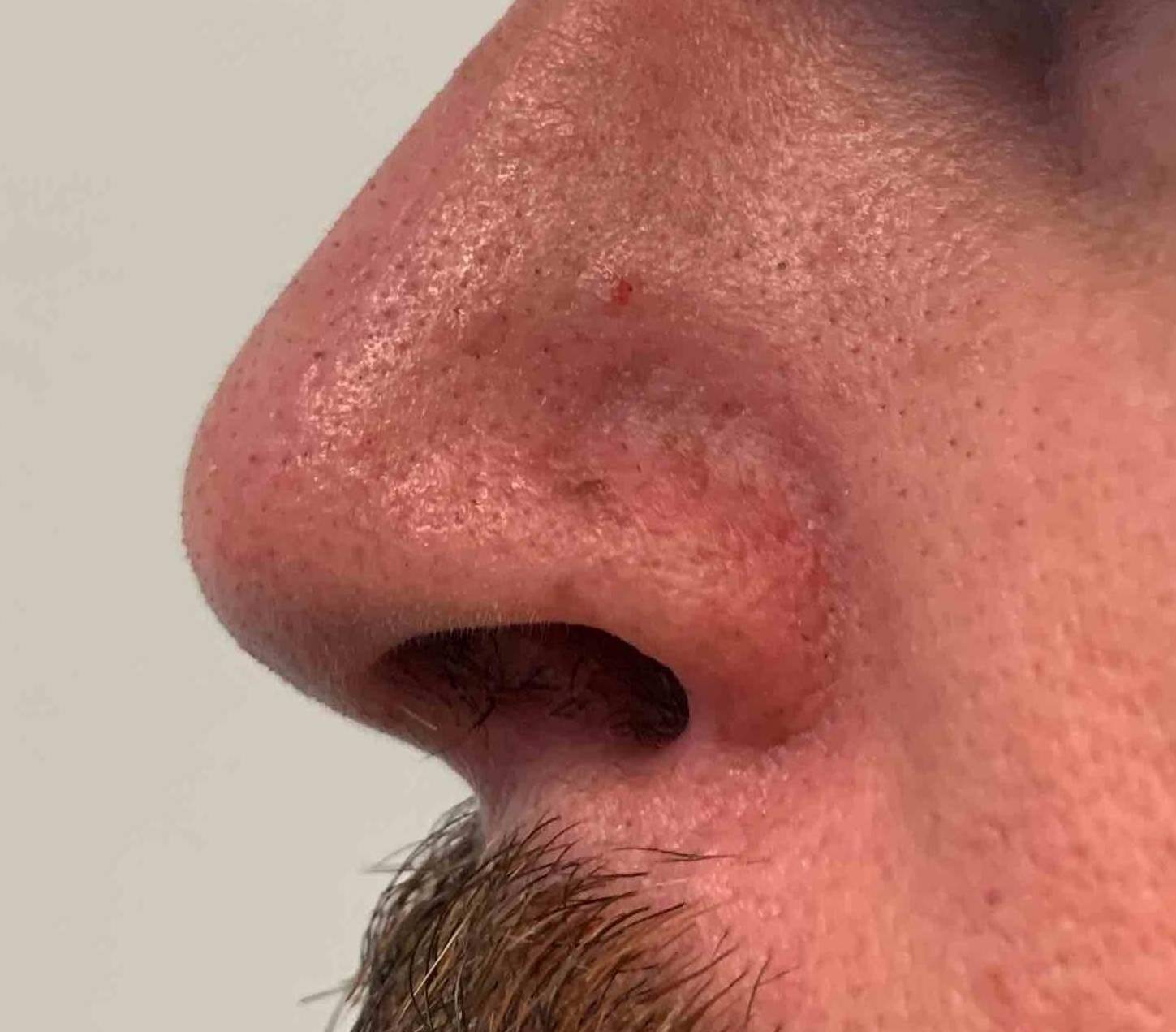 Skin Cancer (18 Radiation Treatment) Case-50 After