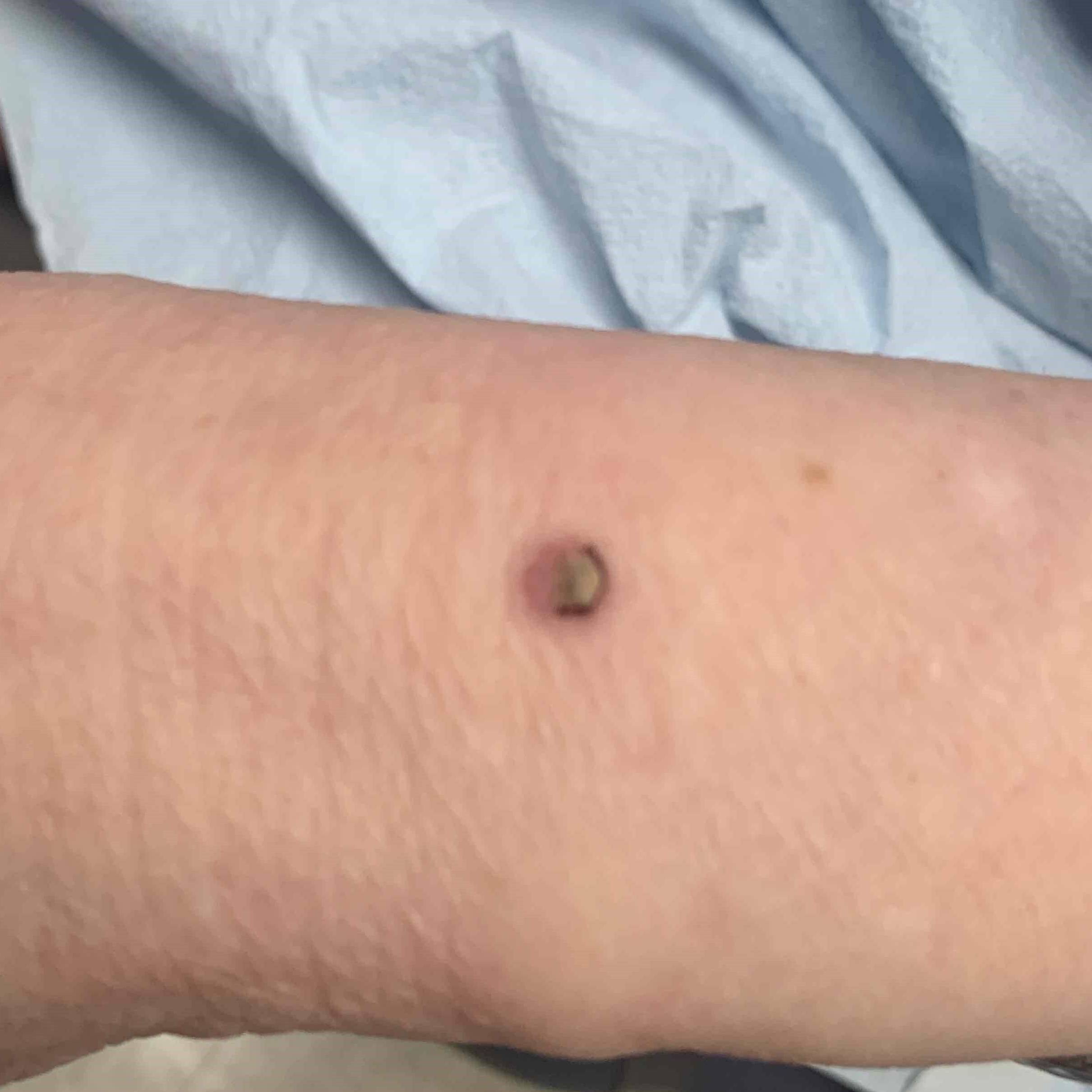 Skin Cancer (14 Radiation Treatment) Case-51 Before