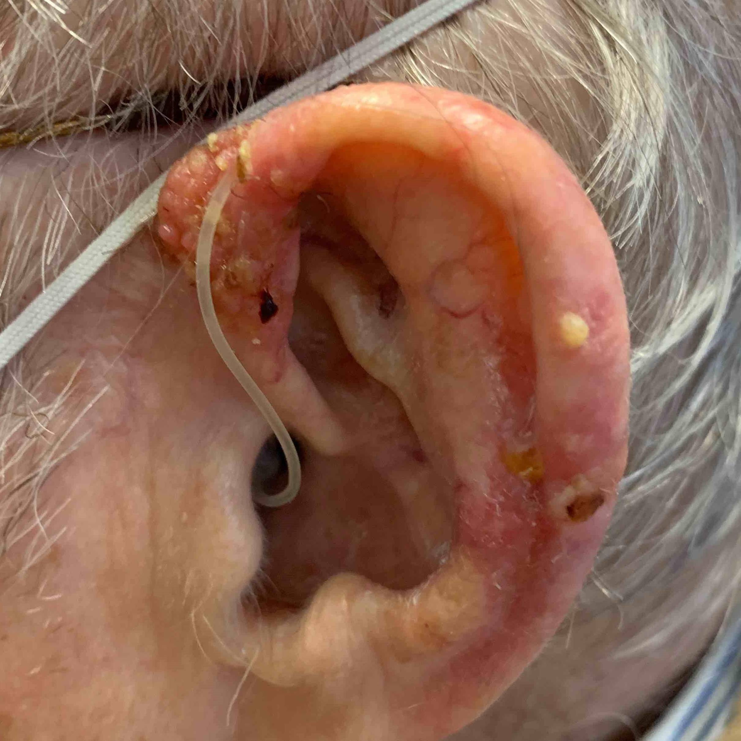 Skin Cancer (17 Radiation Treatment) Case-52 Before