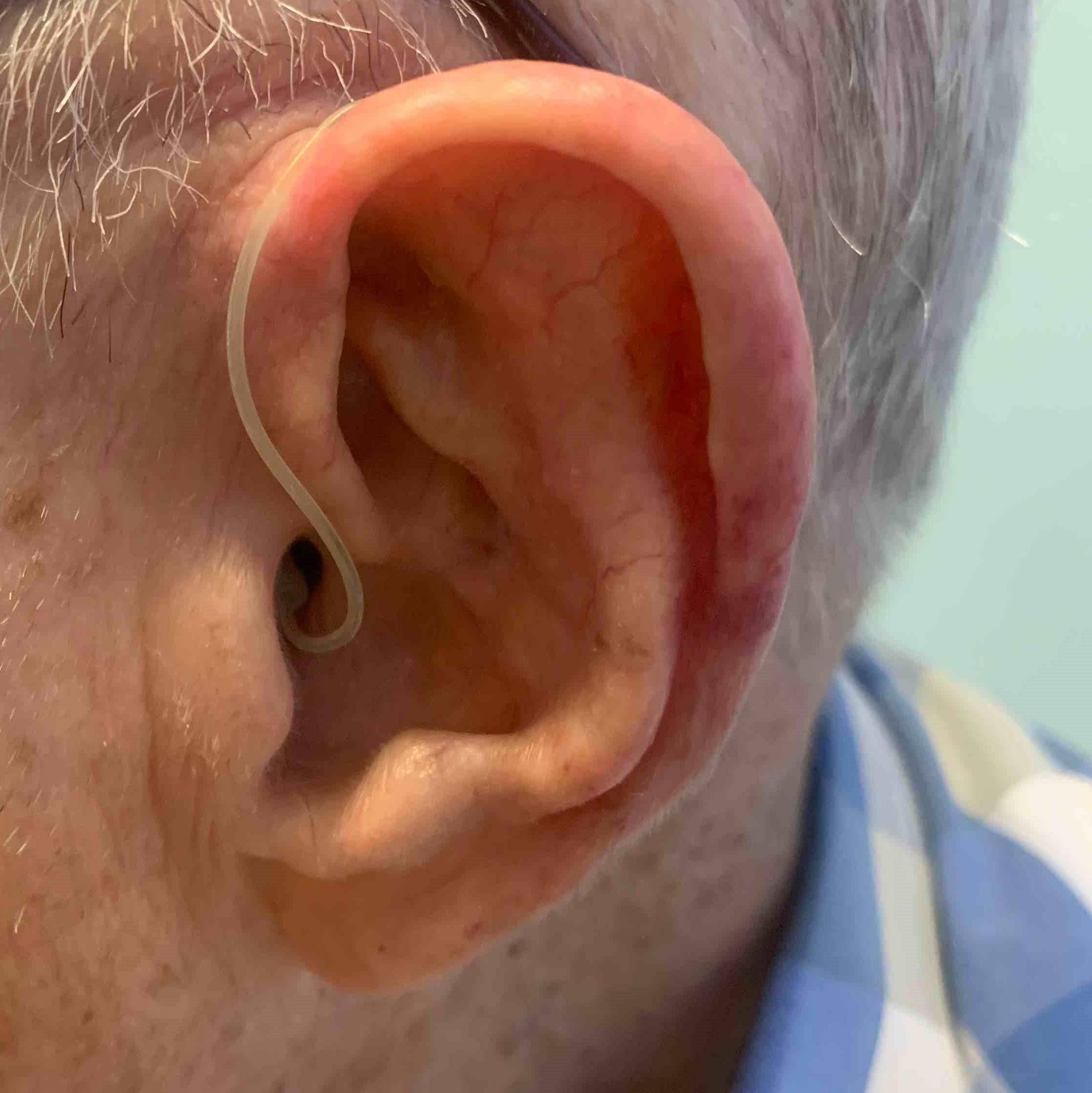 Skin Cancer (17 Radiation Treatment) Case-52 After