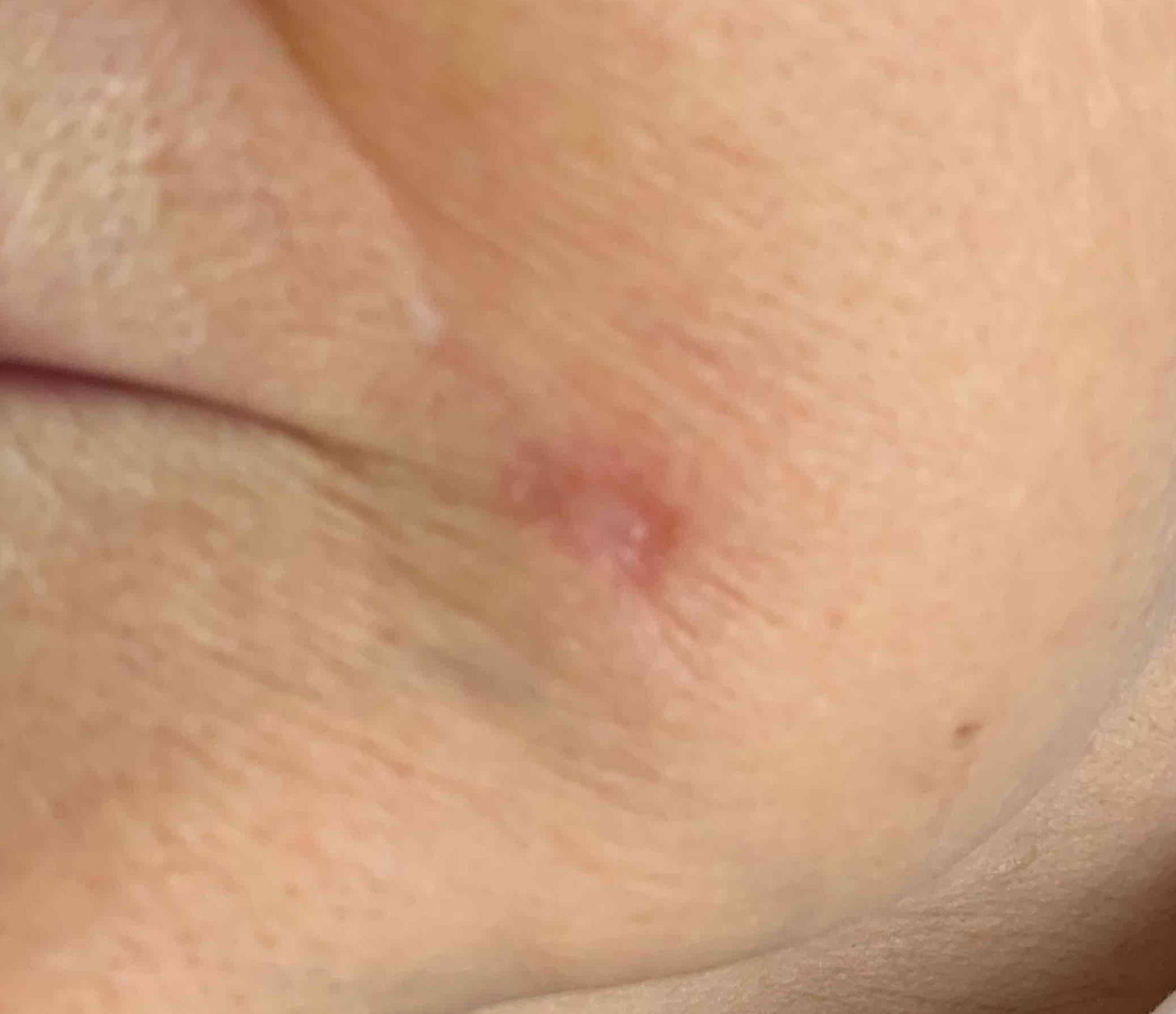 Skin Cancer (17 Radiation Treatment) Case-54 Before