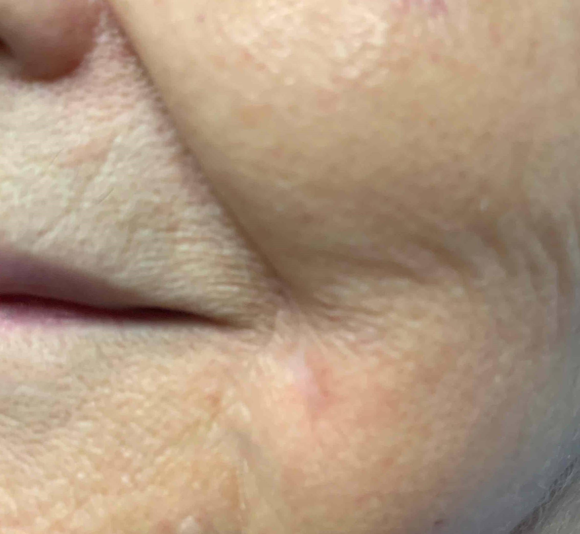 Skin Cancer (17 Radiation Treatment) Case-54 After