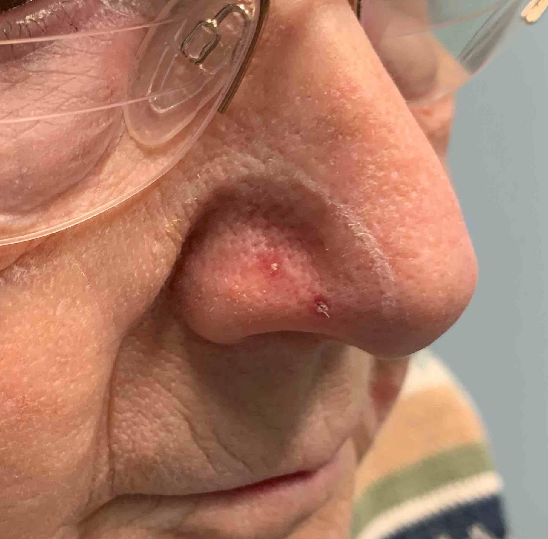 Skin Cancer (18 Radiation Treatment) Case-55 Before
