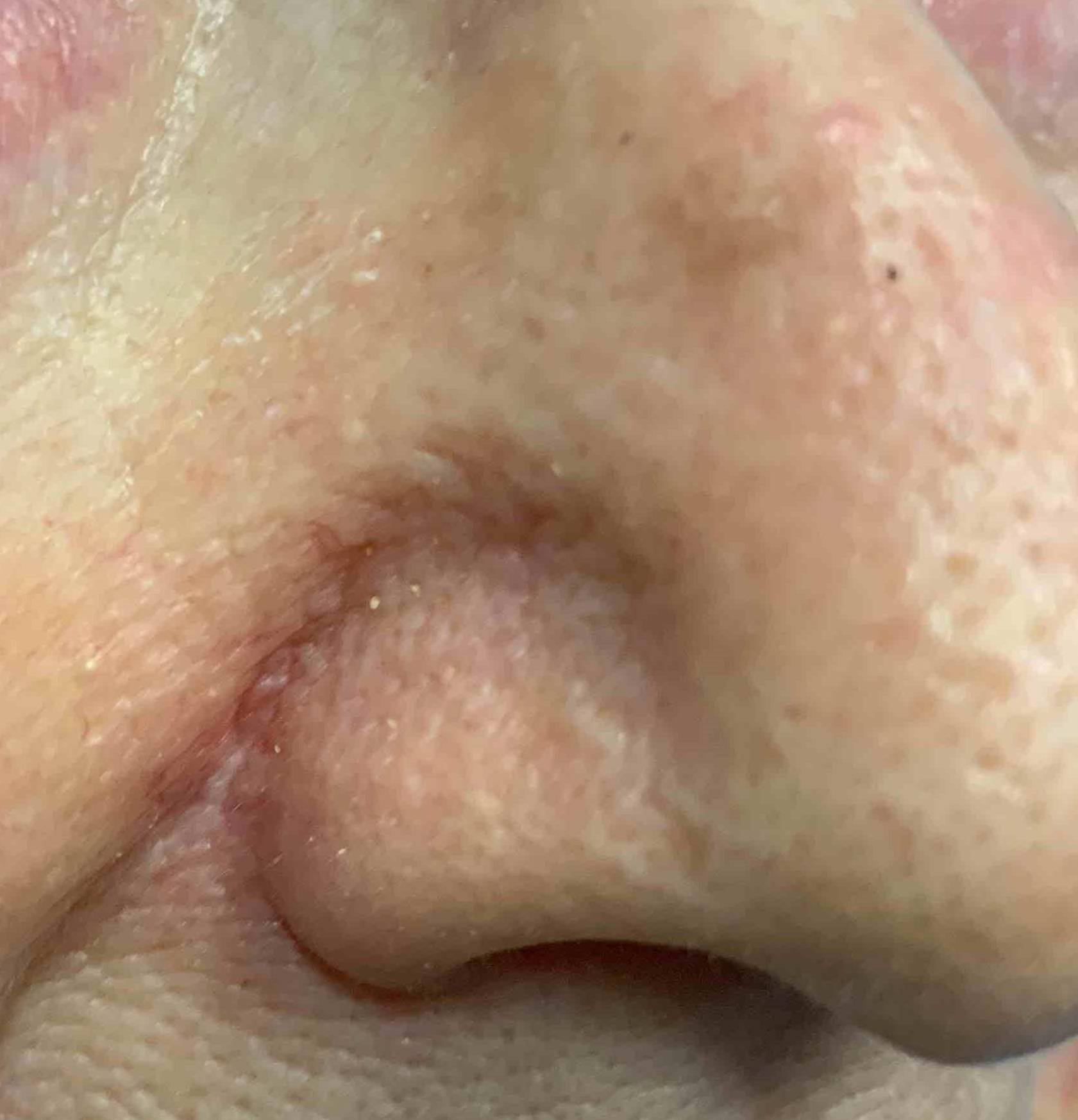 Skin Cancer (18 Radiation Treatment) Case-55 After