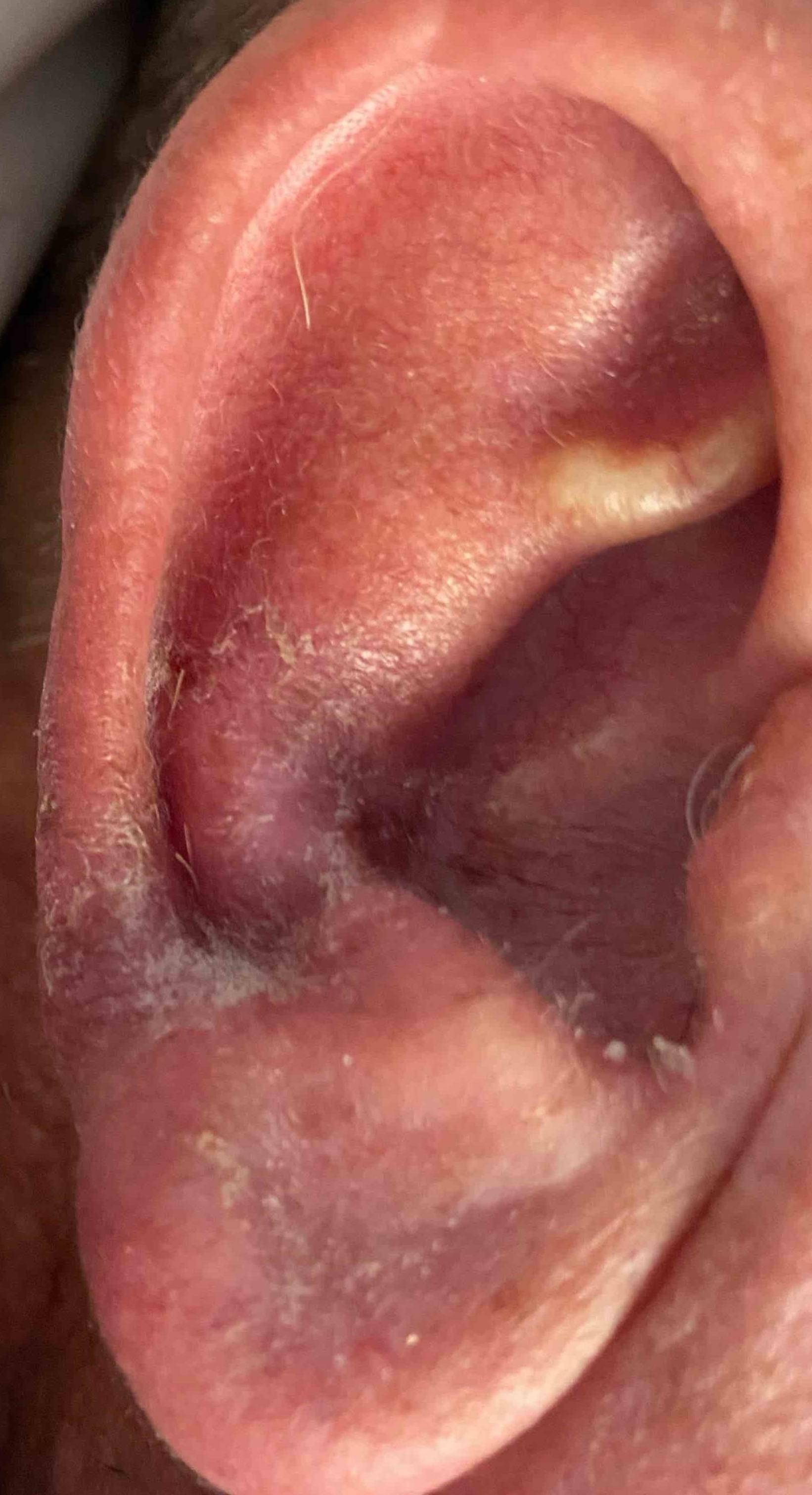 Skin Cancer (17 Radiation Treatment) Case-56 Before