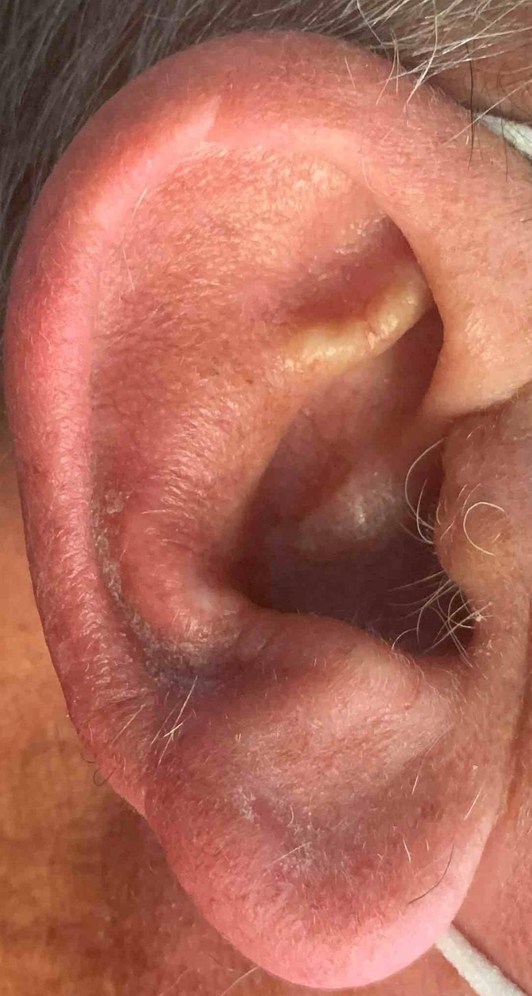 Skin Cancer (17 Radiation Treatment) Case-56 After