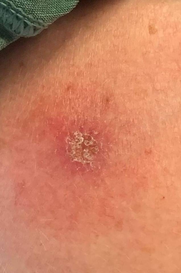 Skin Cancer (14 Radiation Treatment) Case-57 Before