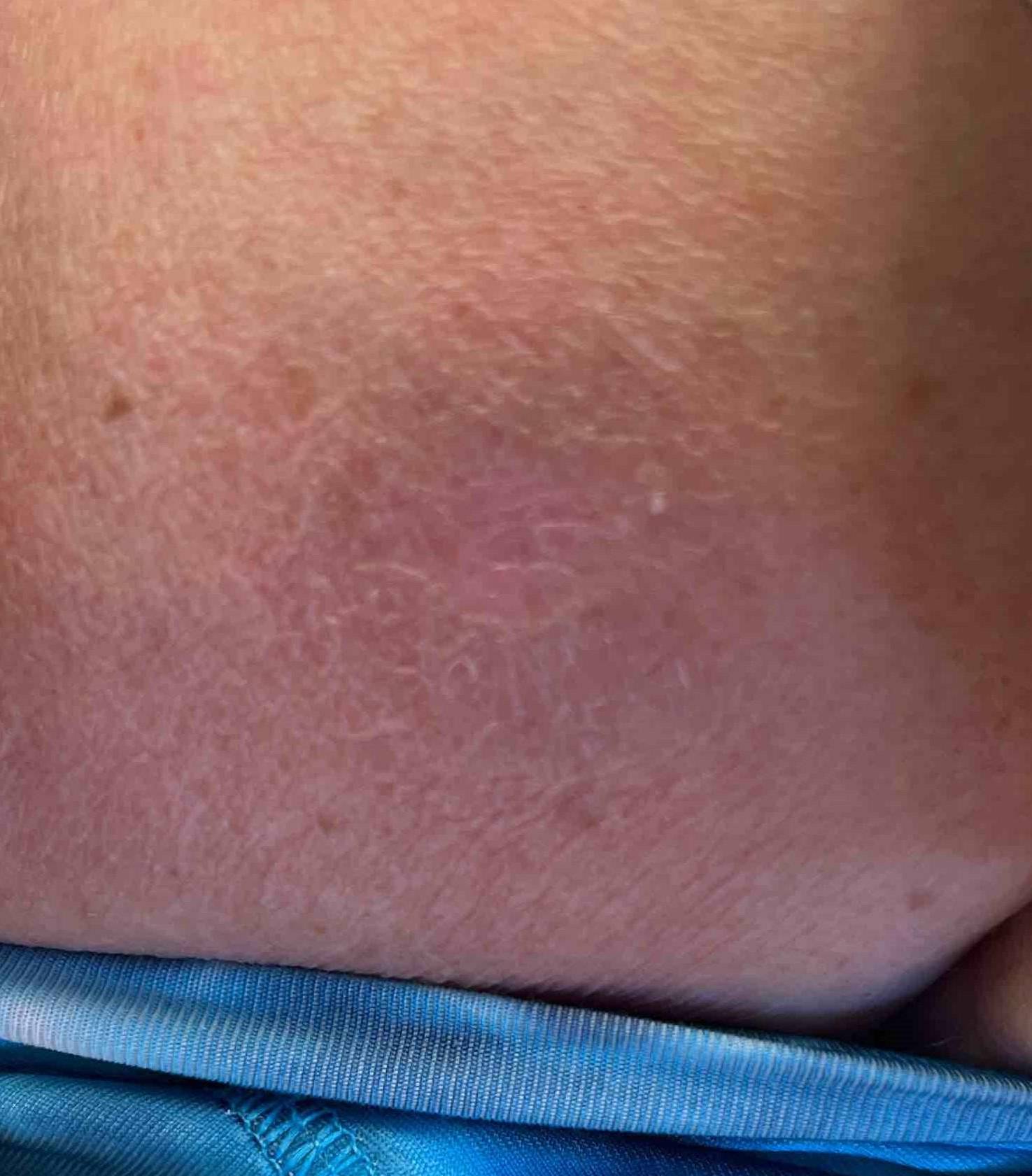 Skin Cancer (14 Radiation Treatment) Case-57 After