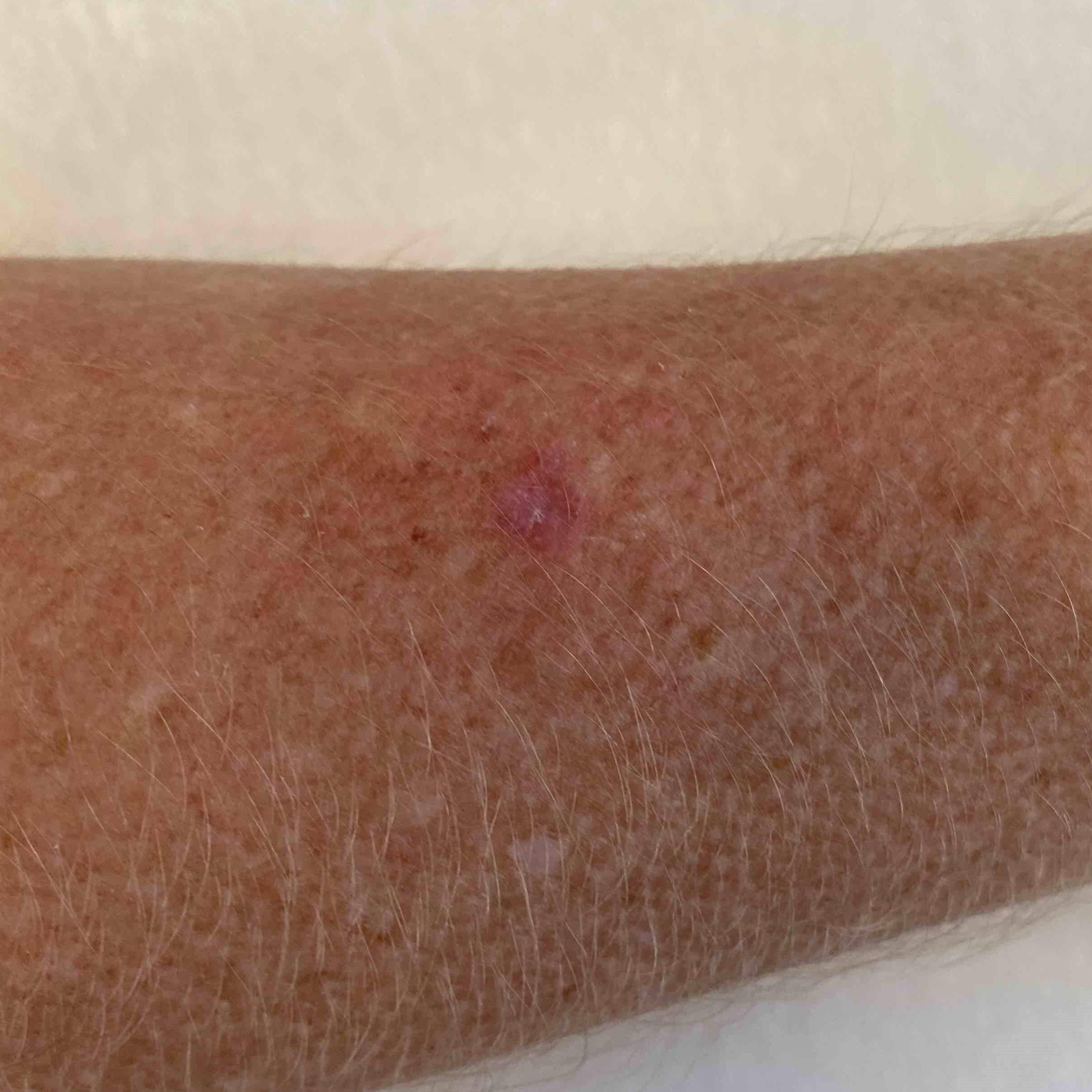 Skin Cancer (14 Radiation Treatment) Case-59 Before