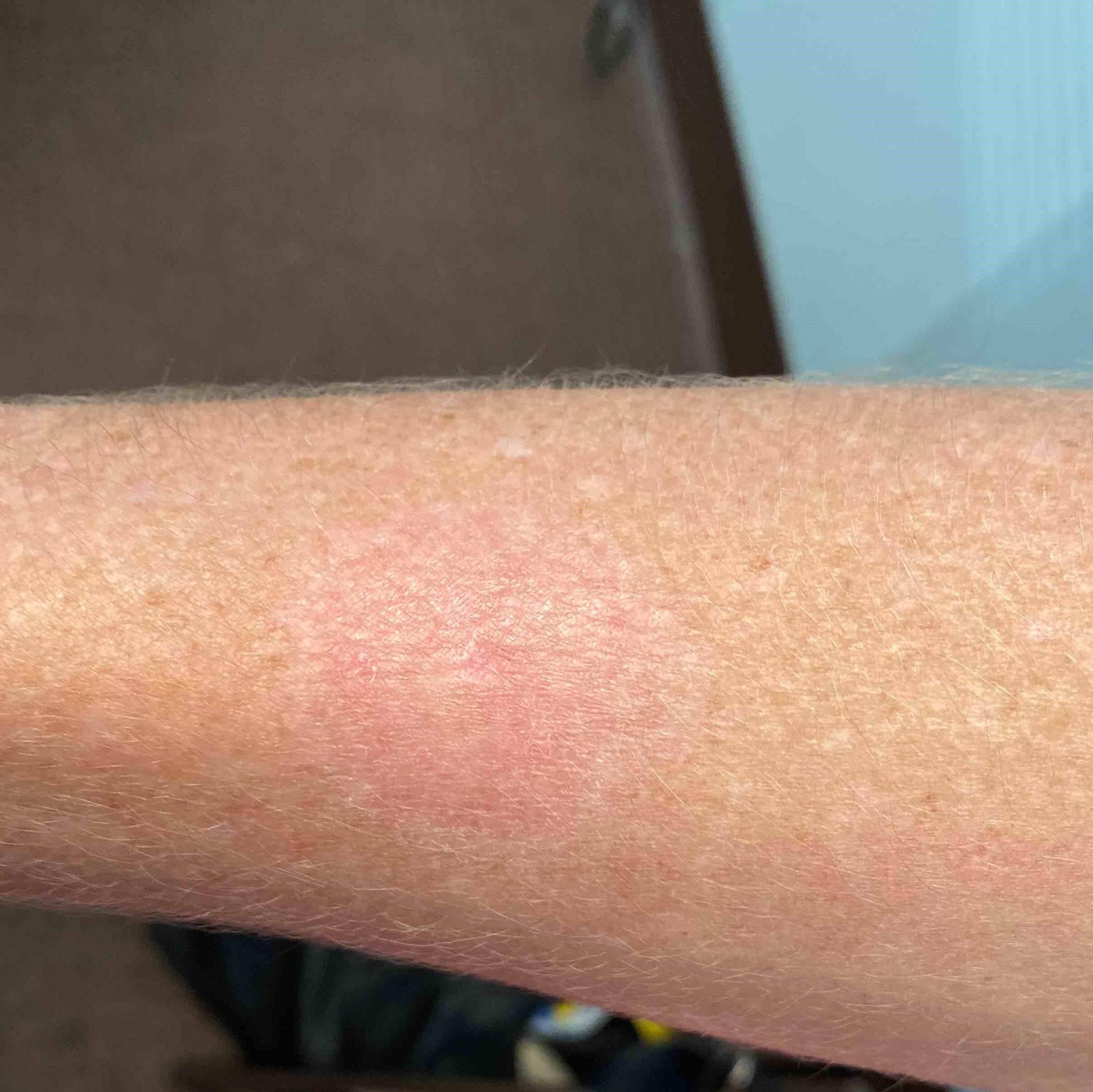Skin Cancer (14 Radiation Treatment) Case-59 After