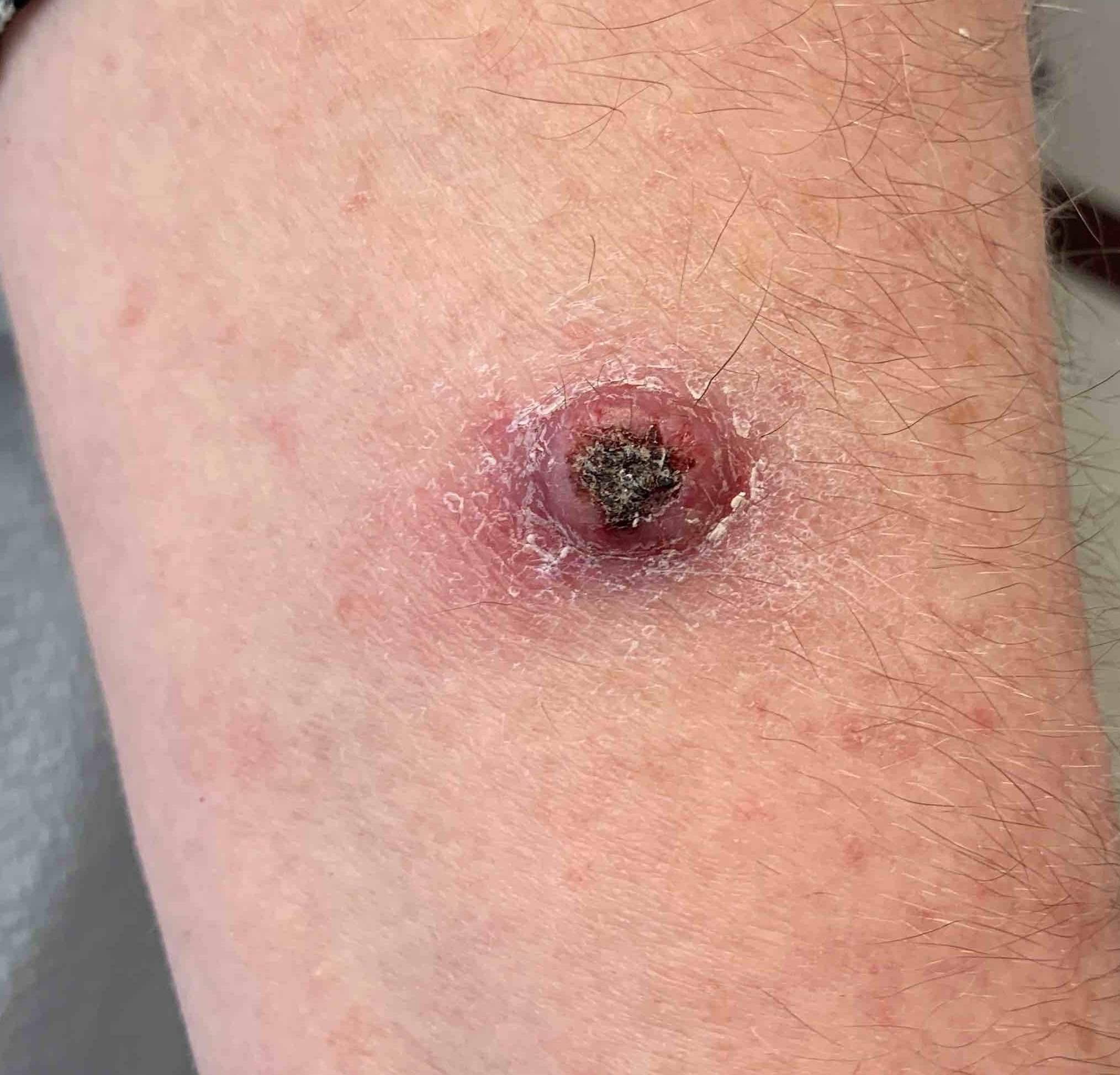 Skin Cancer (14 Radiation Treatment) Case-60 Before