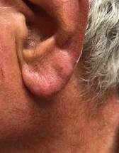 Eczema Before and After Case 2 After