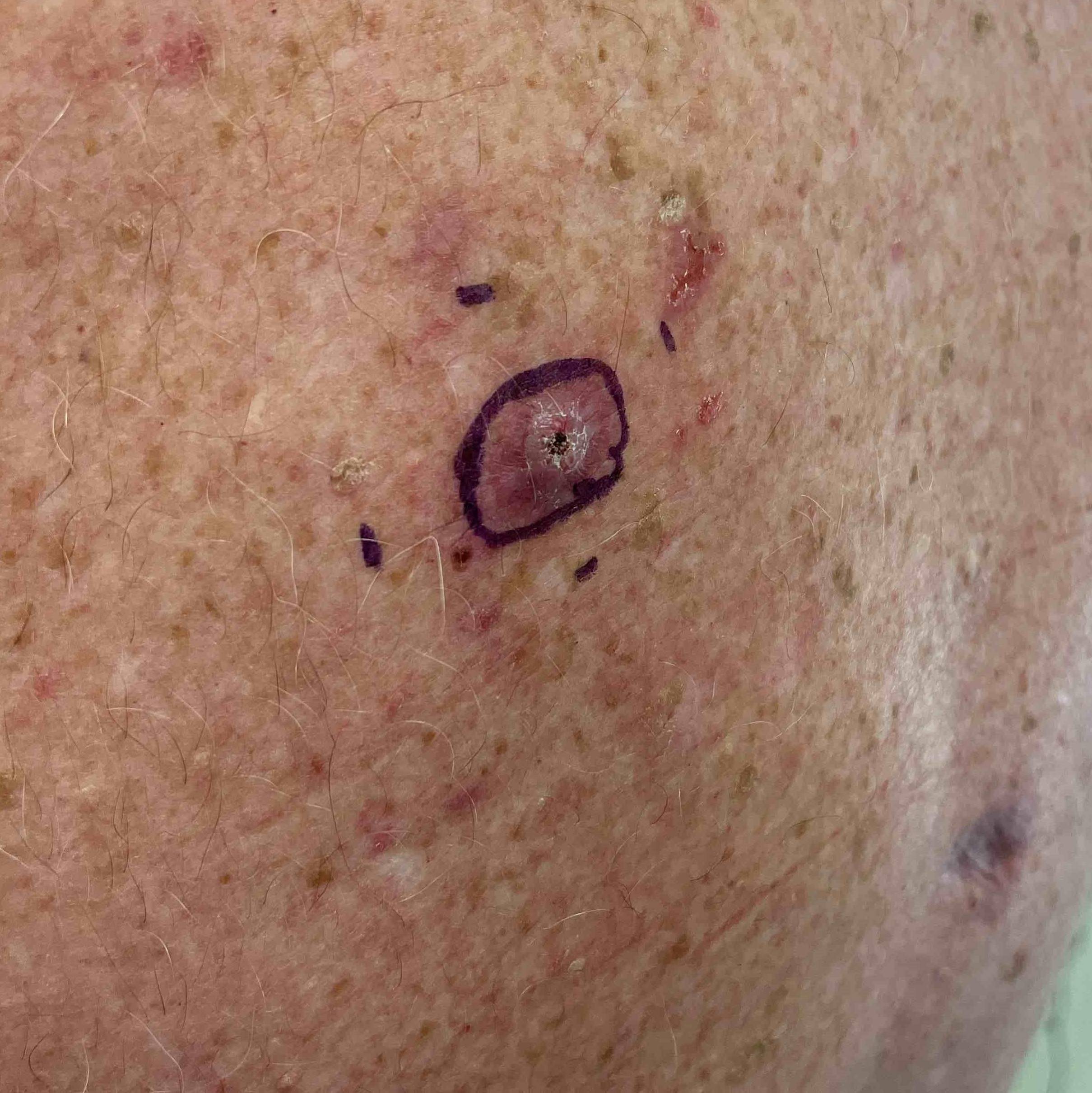 Skin Cancer (Excision) Case-61 Before
