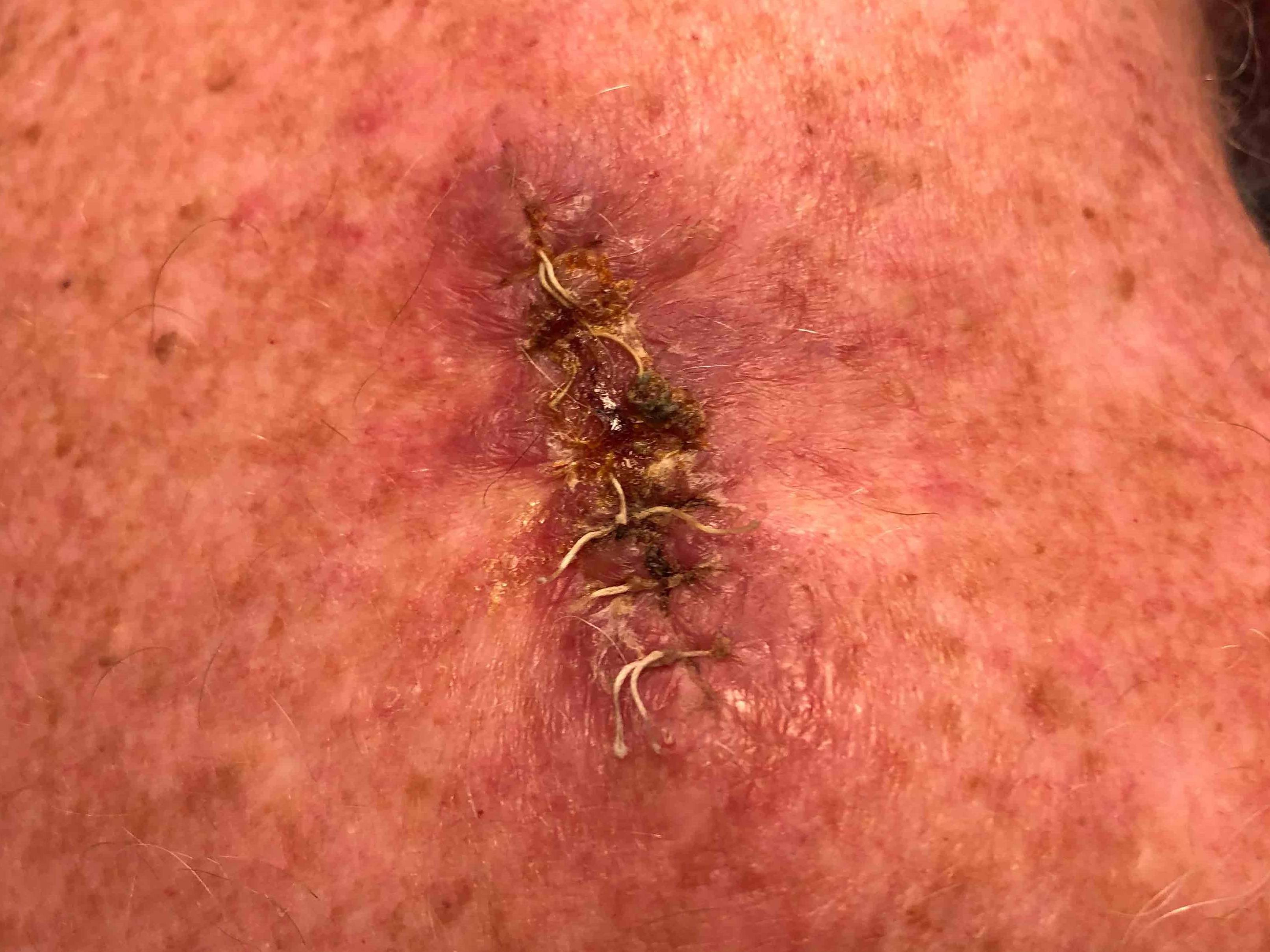 Skin Cancer (Excision) Case-62 After