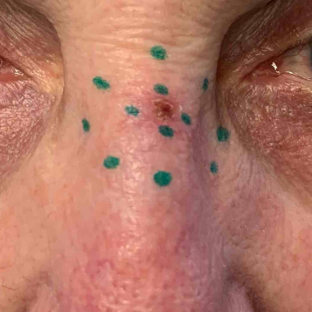 Skin Cancer (17 Radiation Treatment) Case-63 Before