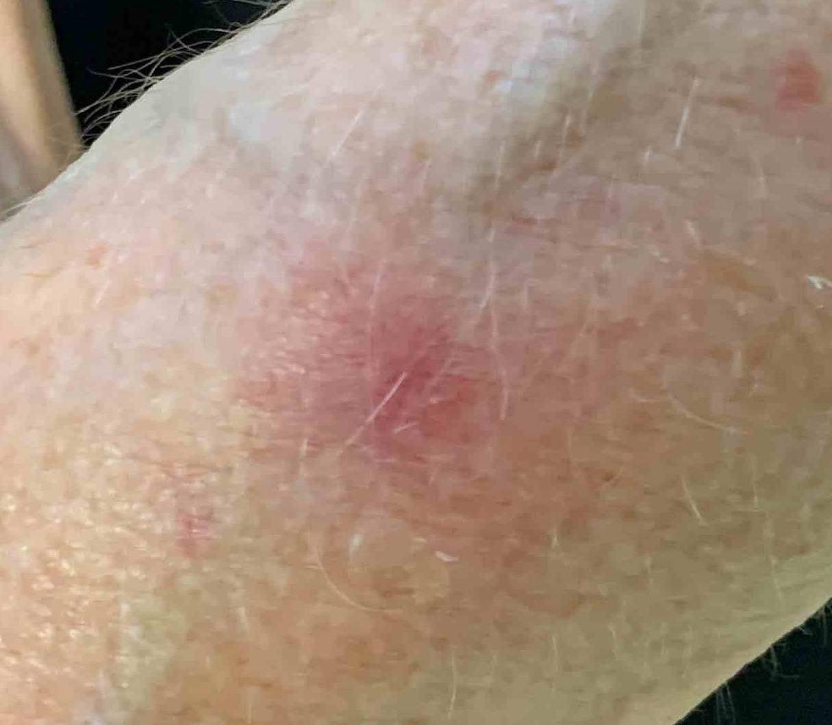 Skin Cancer (14 Radiation Treatment) Case-64 Before