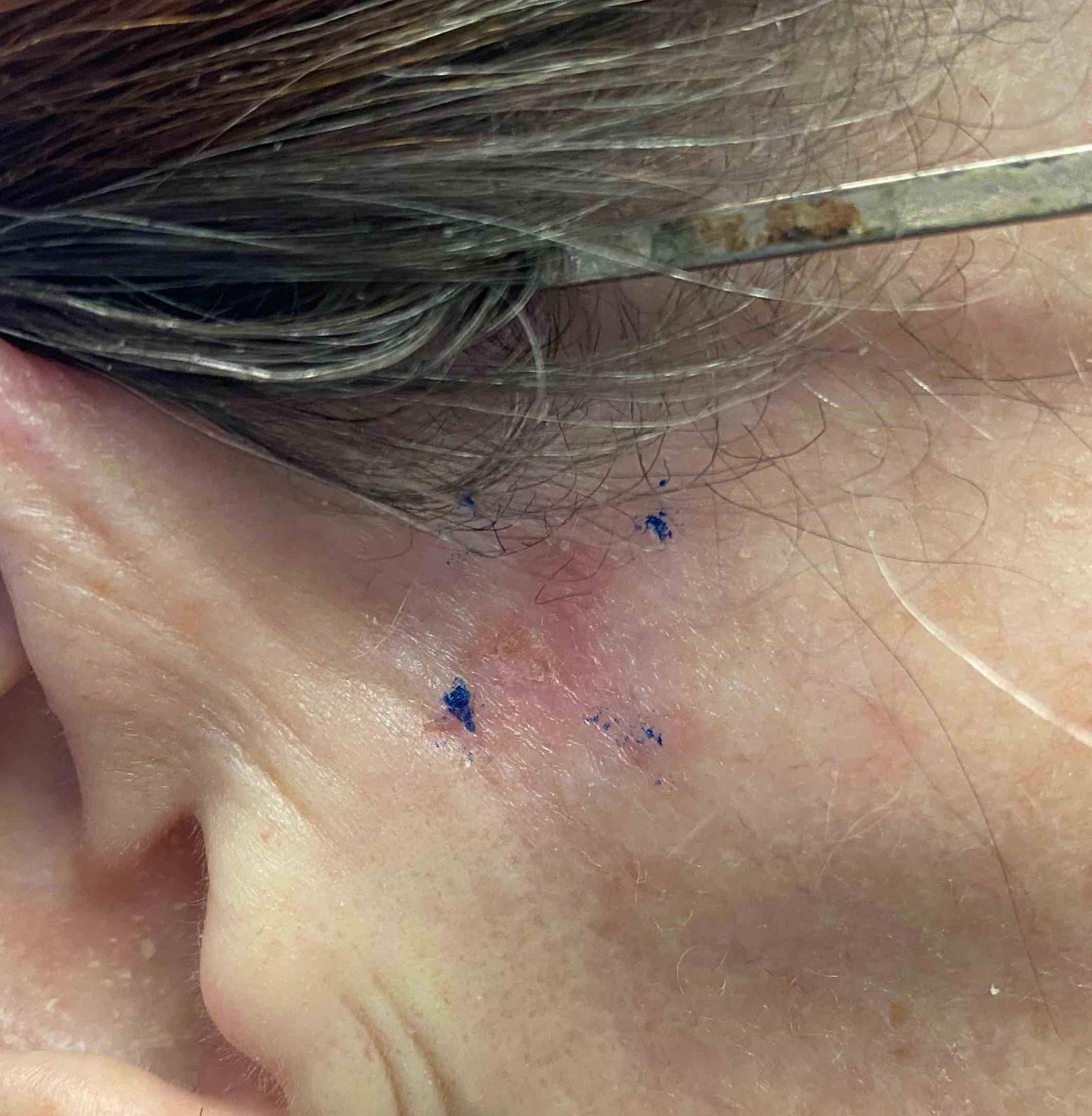 Skin Cancer (Excision) Case-65 Before