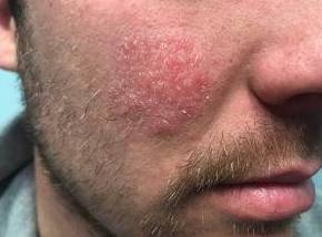 Eczema Before and After Case 3 Before