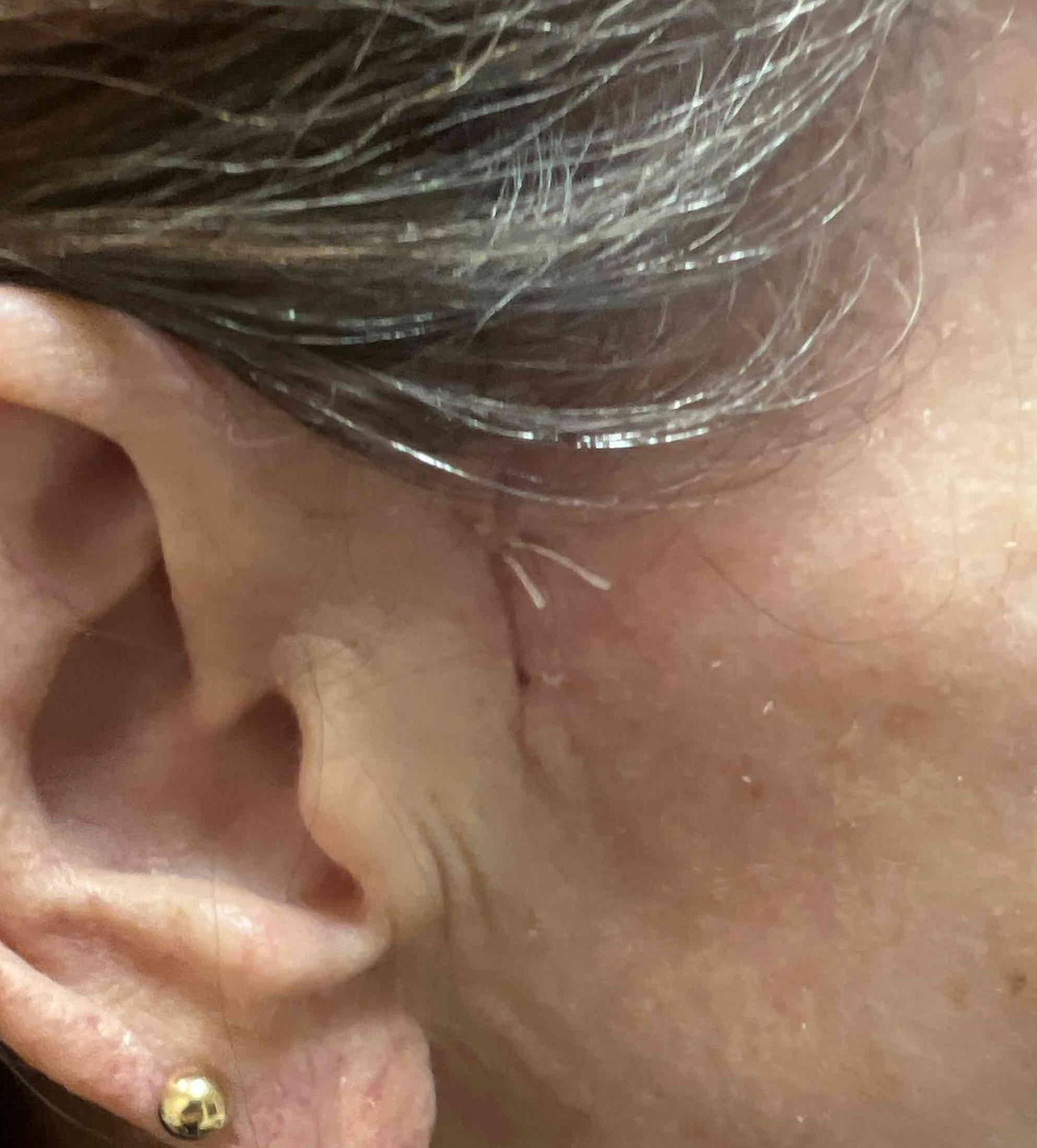 Skin Cancer (Excision) Case-65 After