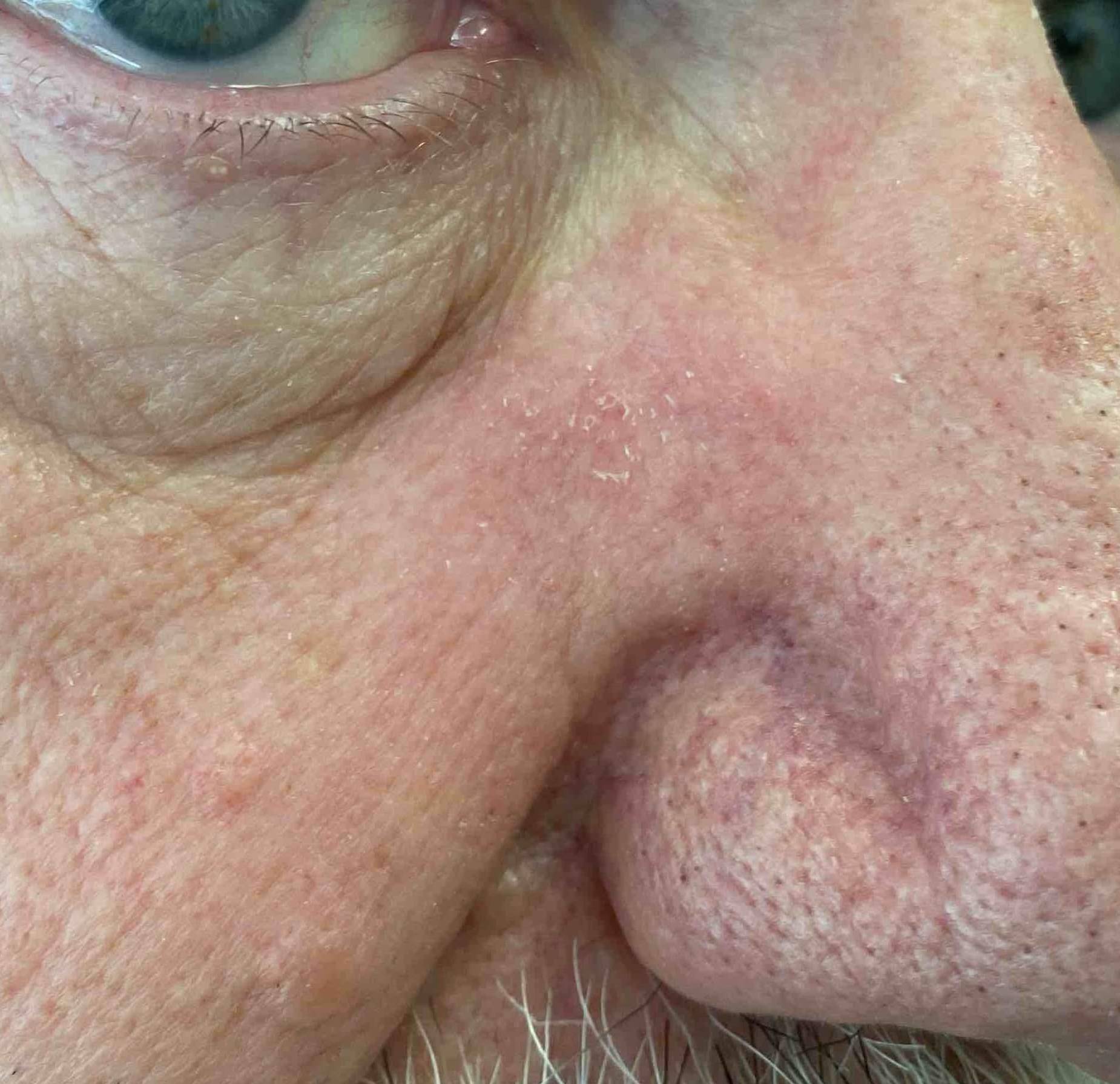 Skin Cancer (17 Radiation Treatment) Case-66 After