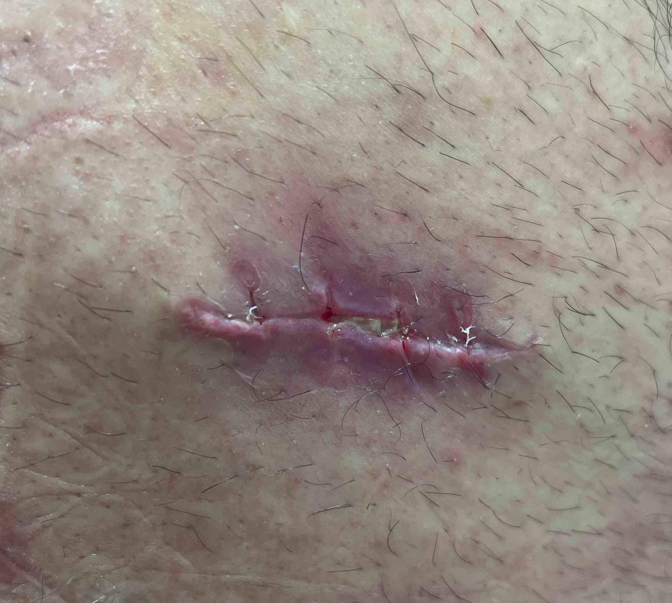 Cyst Removal Before and After Case-15 After