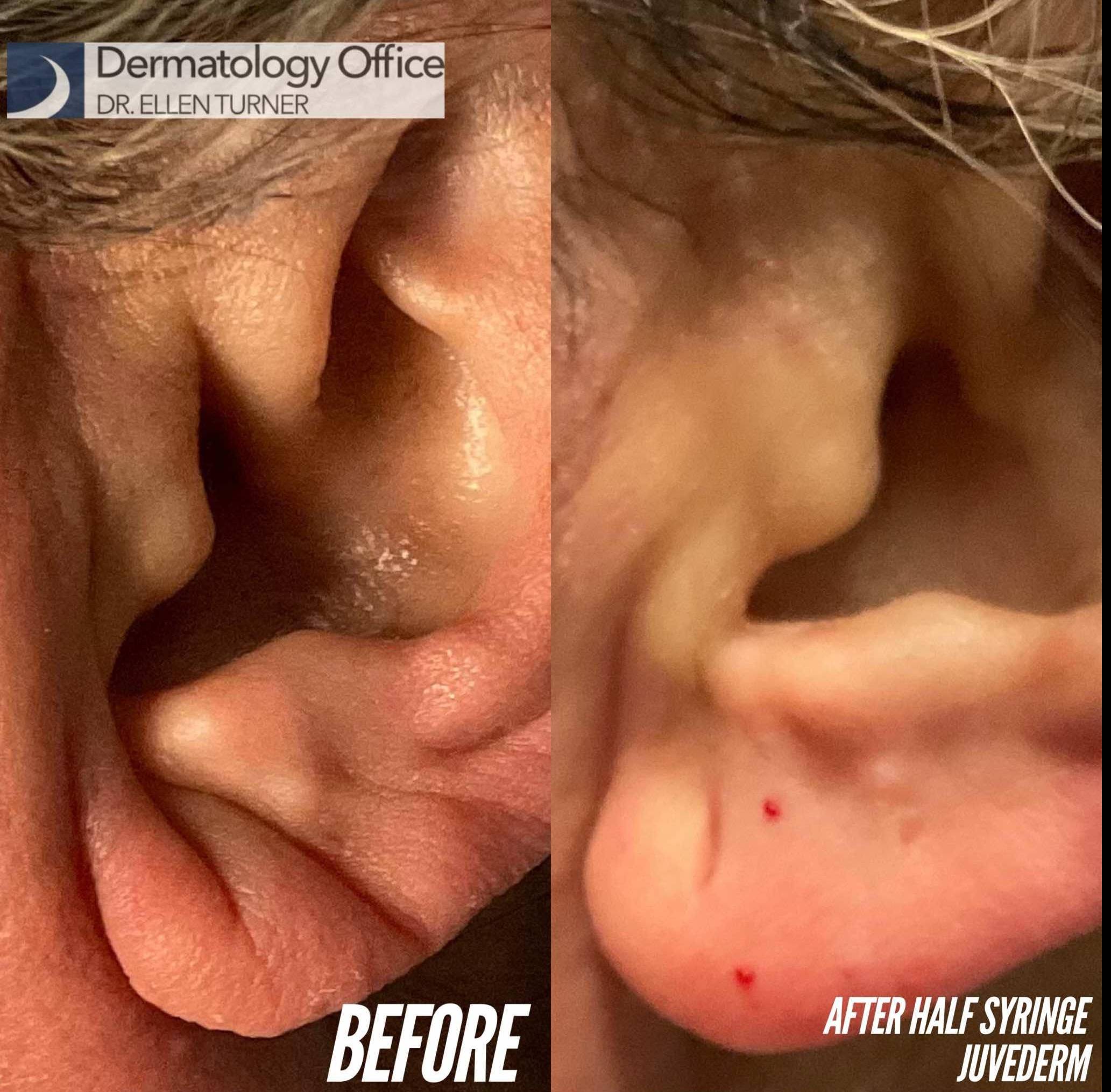 Juvederm (1 Syringe) Case-30 