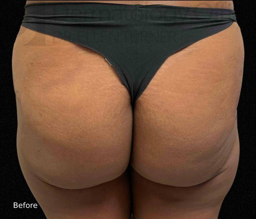 Radiesse (40+ Syringes) Before and After Case-9 Before