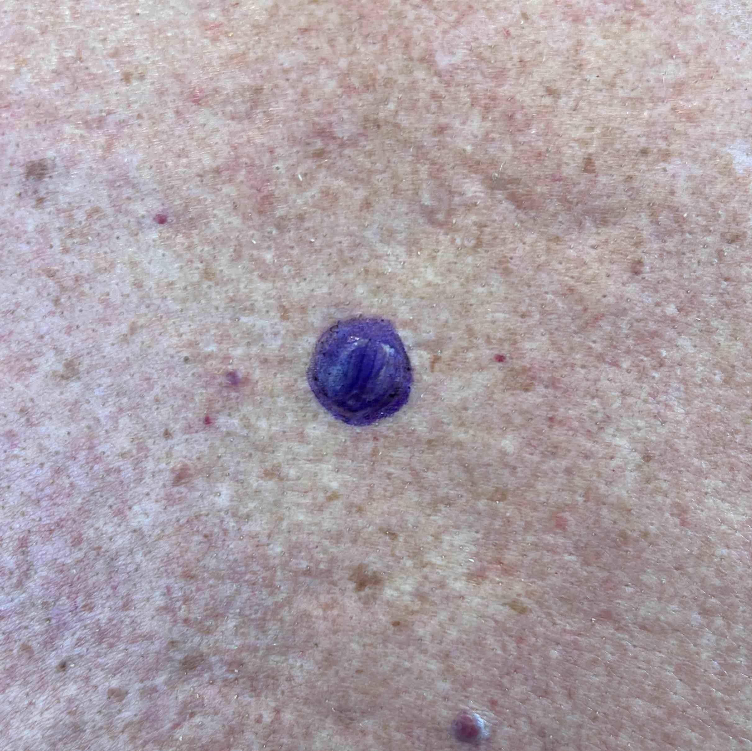 Cyst Removal Before and After Case 16 Before