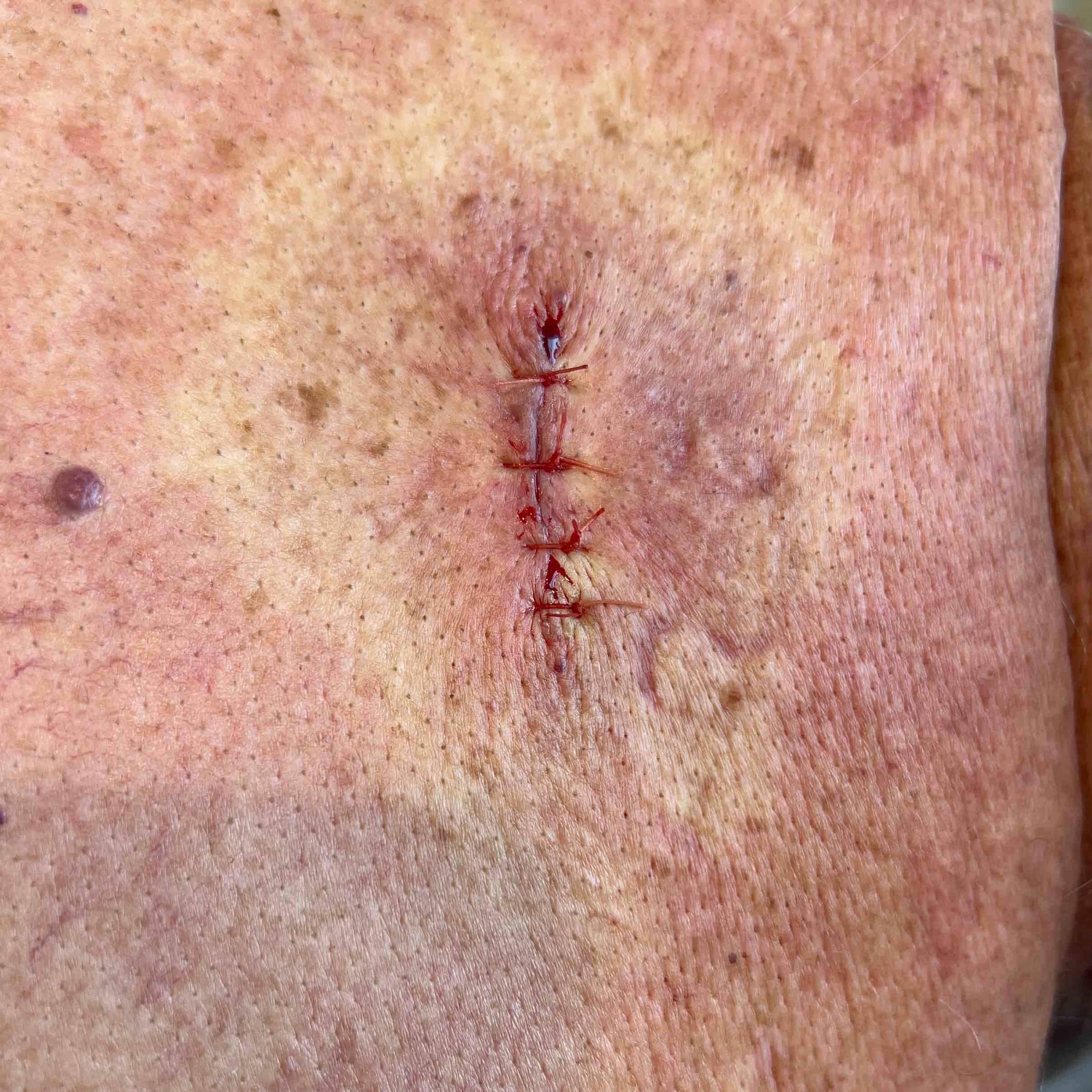 Cyst Removal Before and After Case 16 After