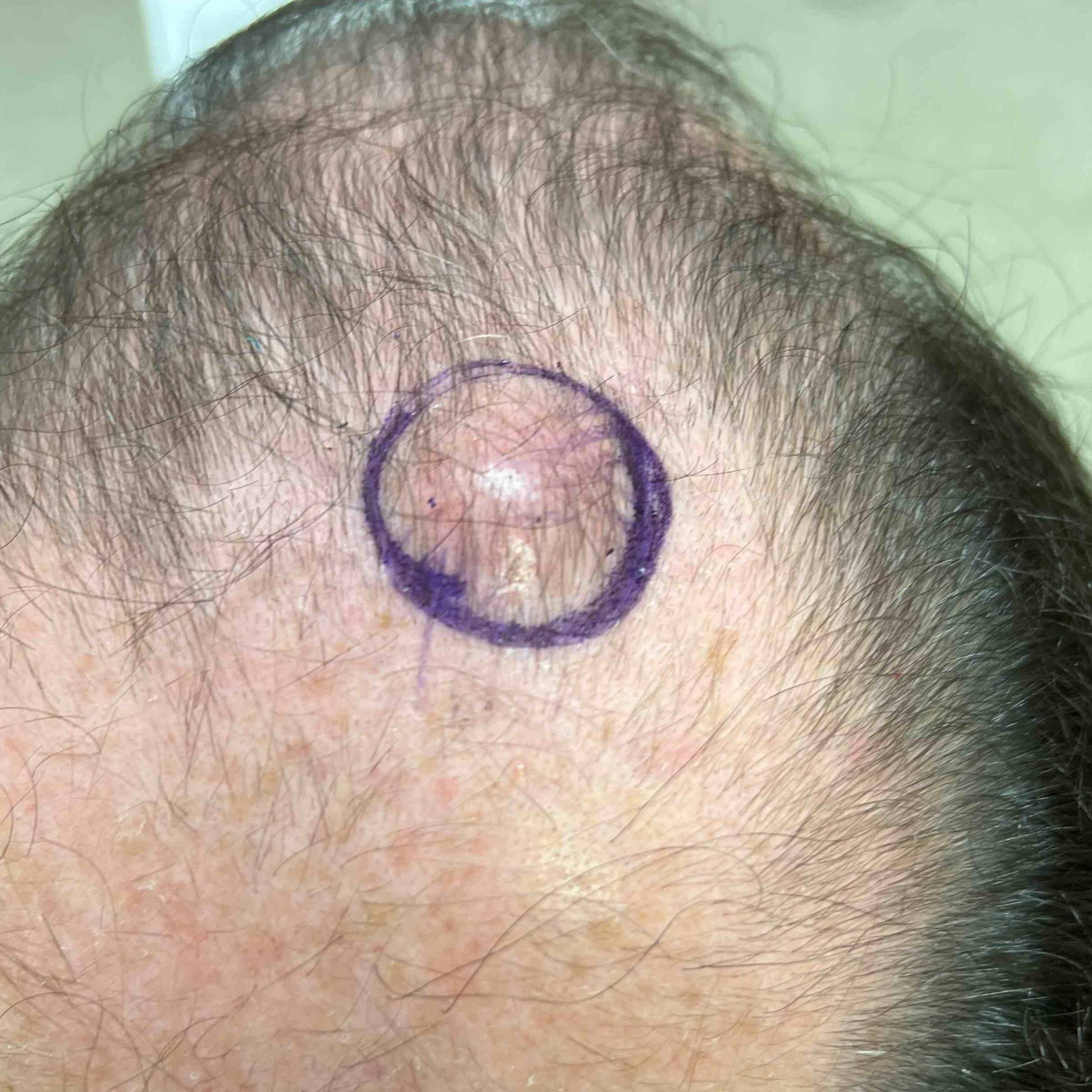 Cyst Removal Before and After Case 17 Before