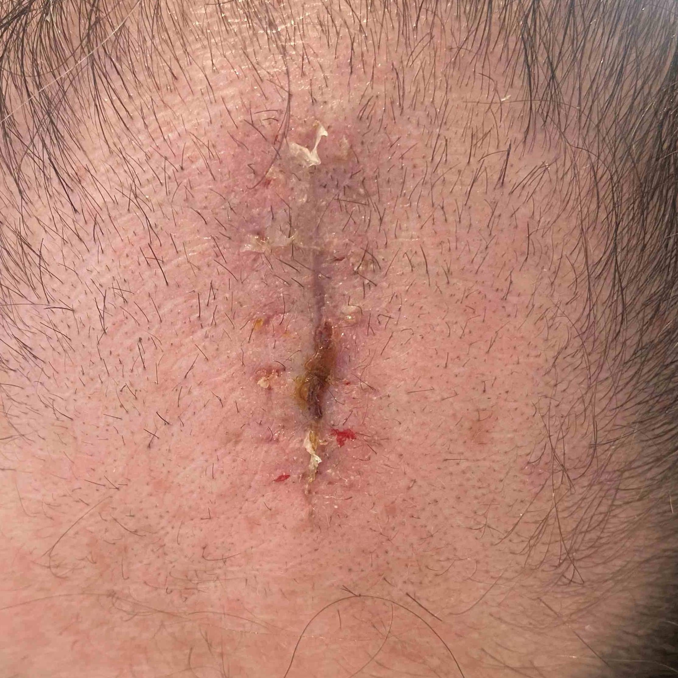 Cyst Removal Before and After Case 17 After