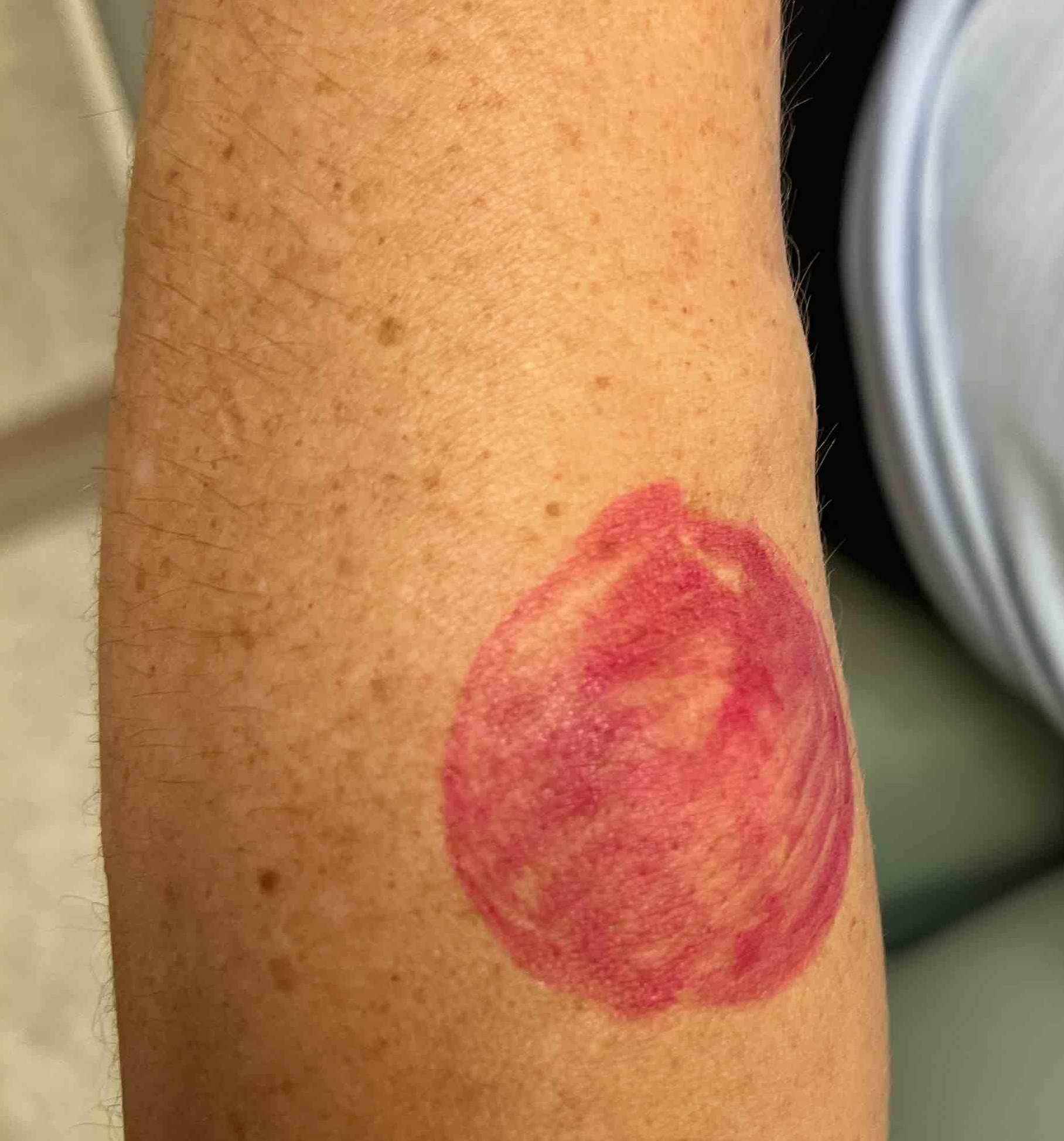 Lipoma Before and After Case 6 Before